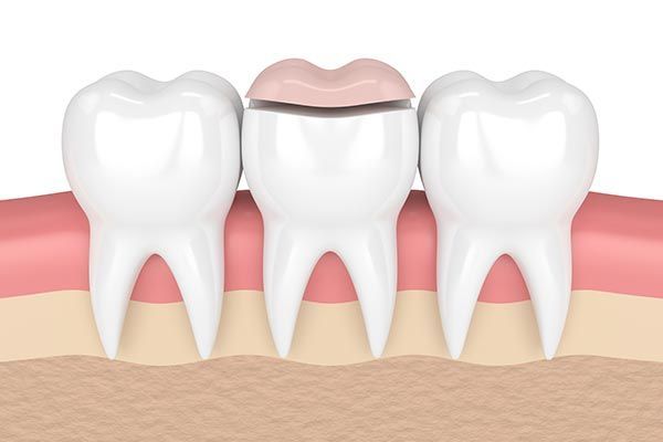How a Cosmetic Dentist Can Place Inlays and Onlays