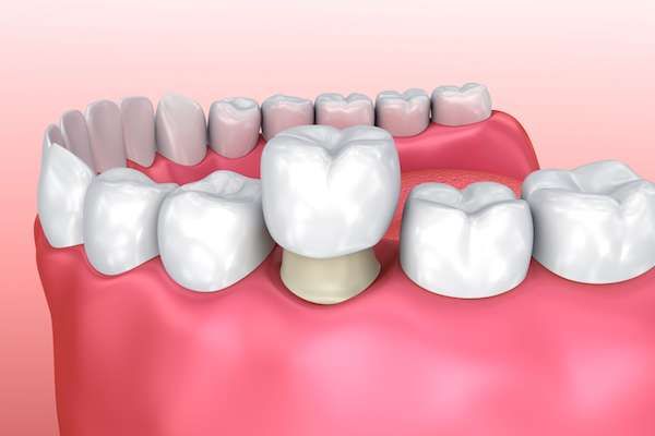 Permanent Dental Crowns vs. Temporary: Is There a Difference