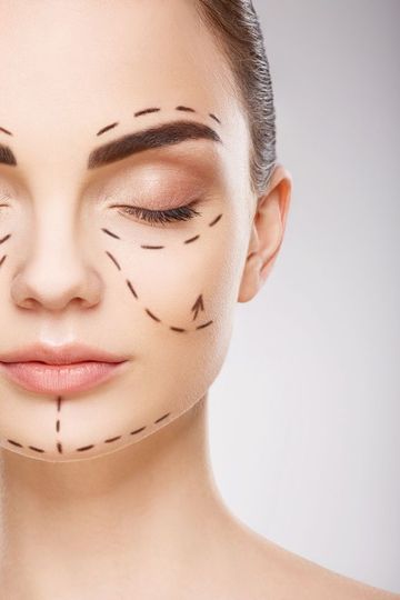 Primo piano del volto di una donna con linee di contorno tratteggiate che indicano le aree sottoposte a chirurgia estetica o trattamenti facciali.