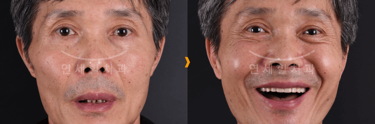 Before and after photo of a man. Before, mouth closed with few teeth; after, smiling with full set of teeth.