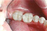 A close up of a person 's teeth in their mouth.