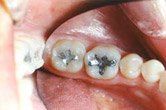 A close up of a person 's teeth with a hole in them.