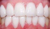 A close up of a person 's teeth with white teeth.