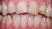 A close up of a person 's teeth with a broken tooth.