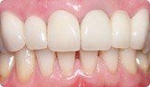A close up of a person 's teeth with white teeth.