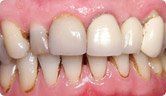 A close up of a person 's teeth with a lot of plaque on them.