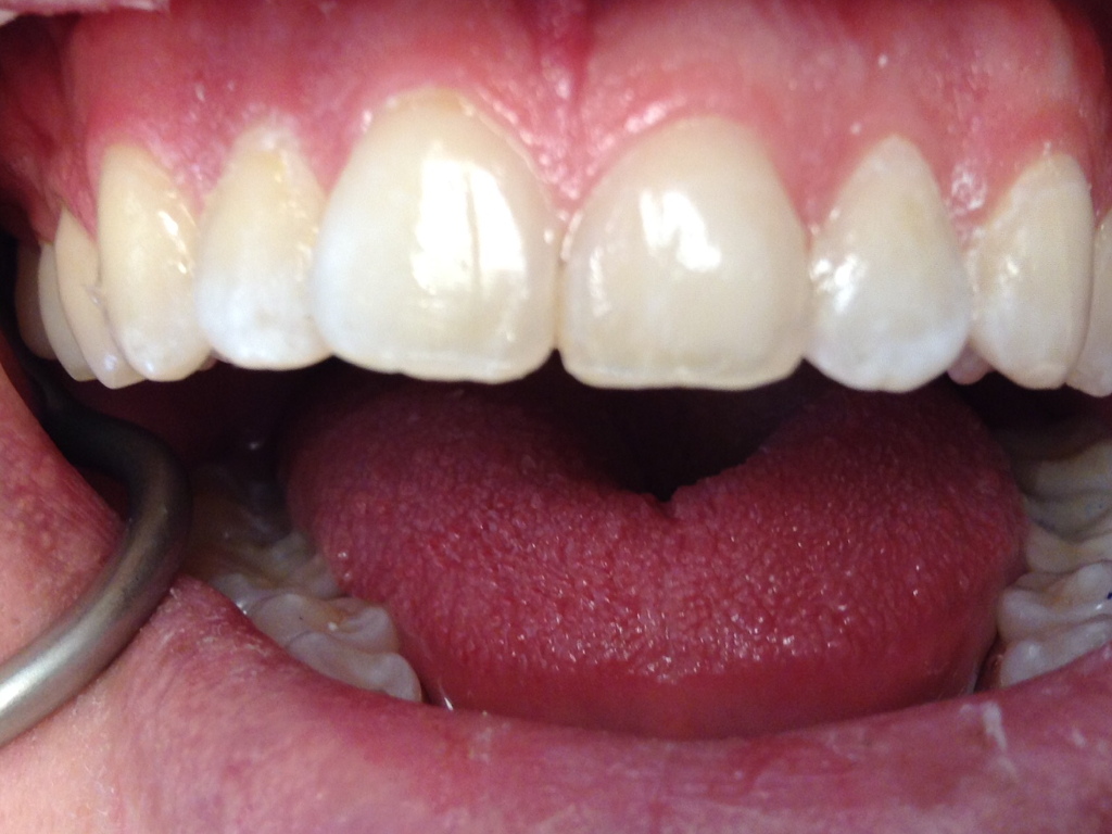 A close up of a person 's teeth and tongue.