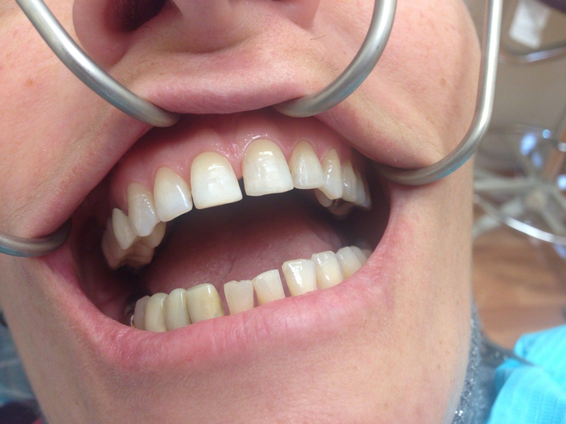A person is getting their teeth examined by a dentist.