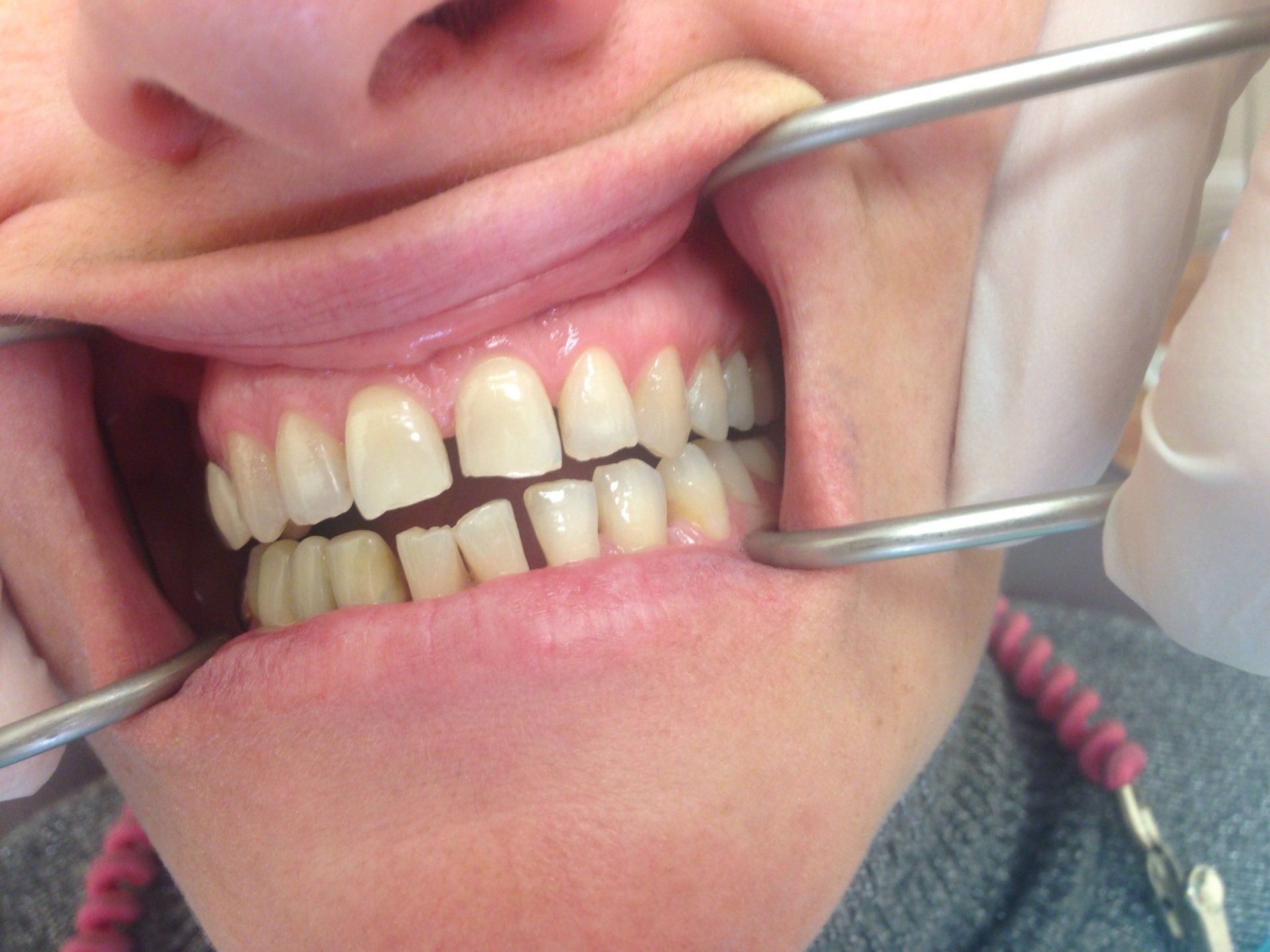 A close up of a person 's teeth with a pair of tweezers