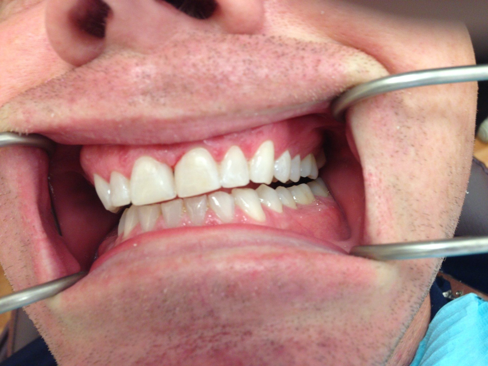 A man is getting his teeth examined by a dentist.
