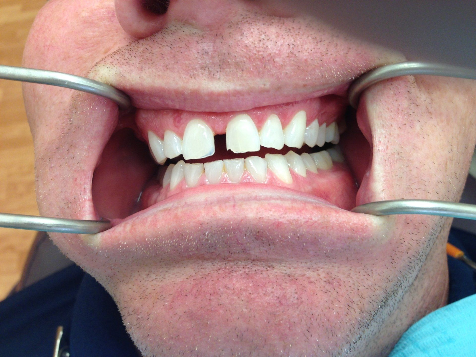 A man is getting his teeth examined by a dentist