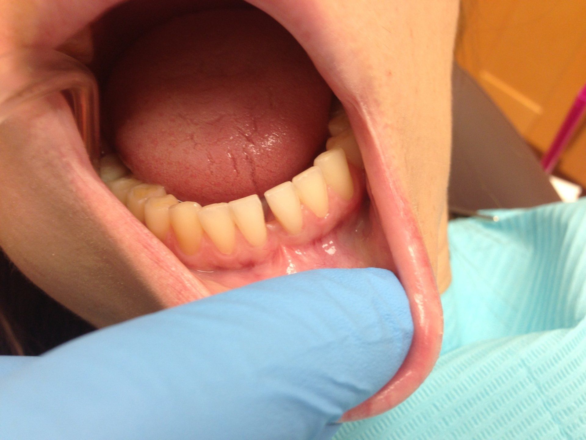 A person is getting their teeth examined by a dentist
