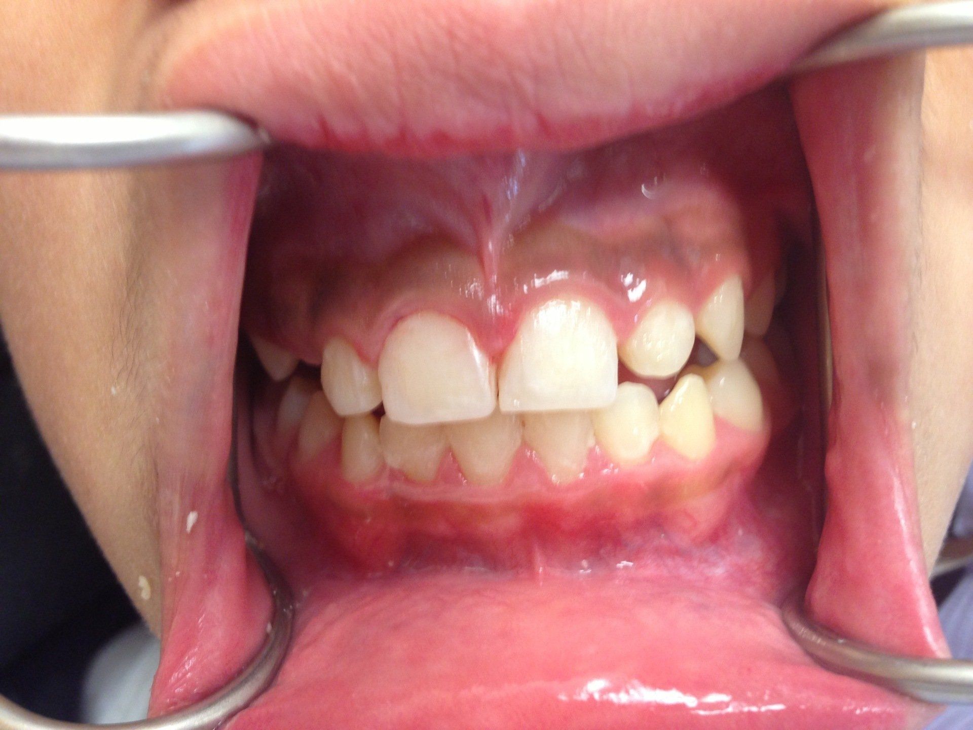 A close up of a person 's mouth with a pair of tweezers in it.