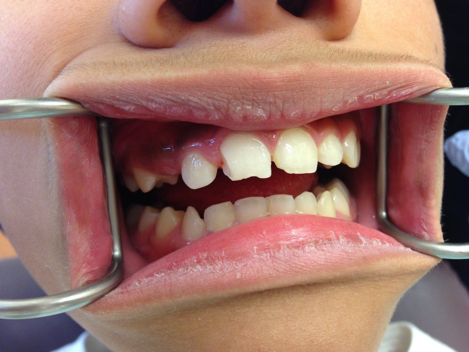 A close up of a person 's mouth with a metal device in it