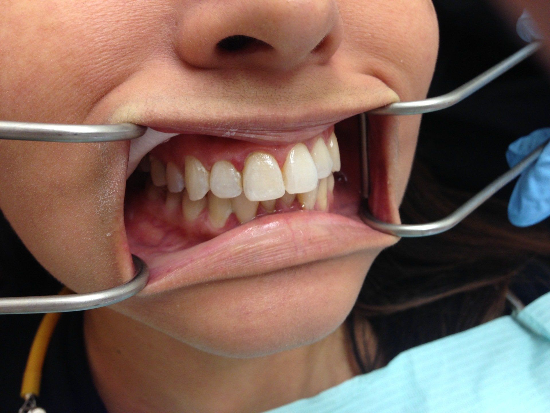 A woman is getting her teeth examined by a dentist.