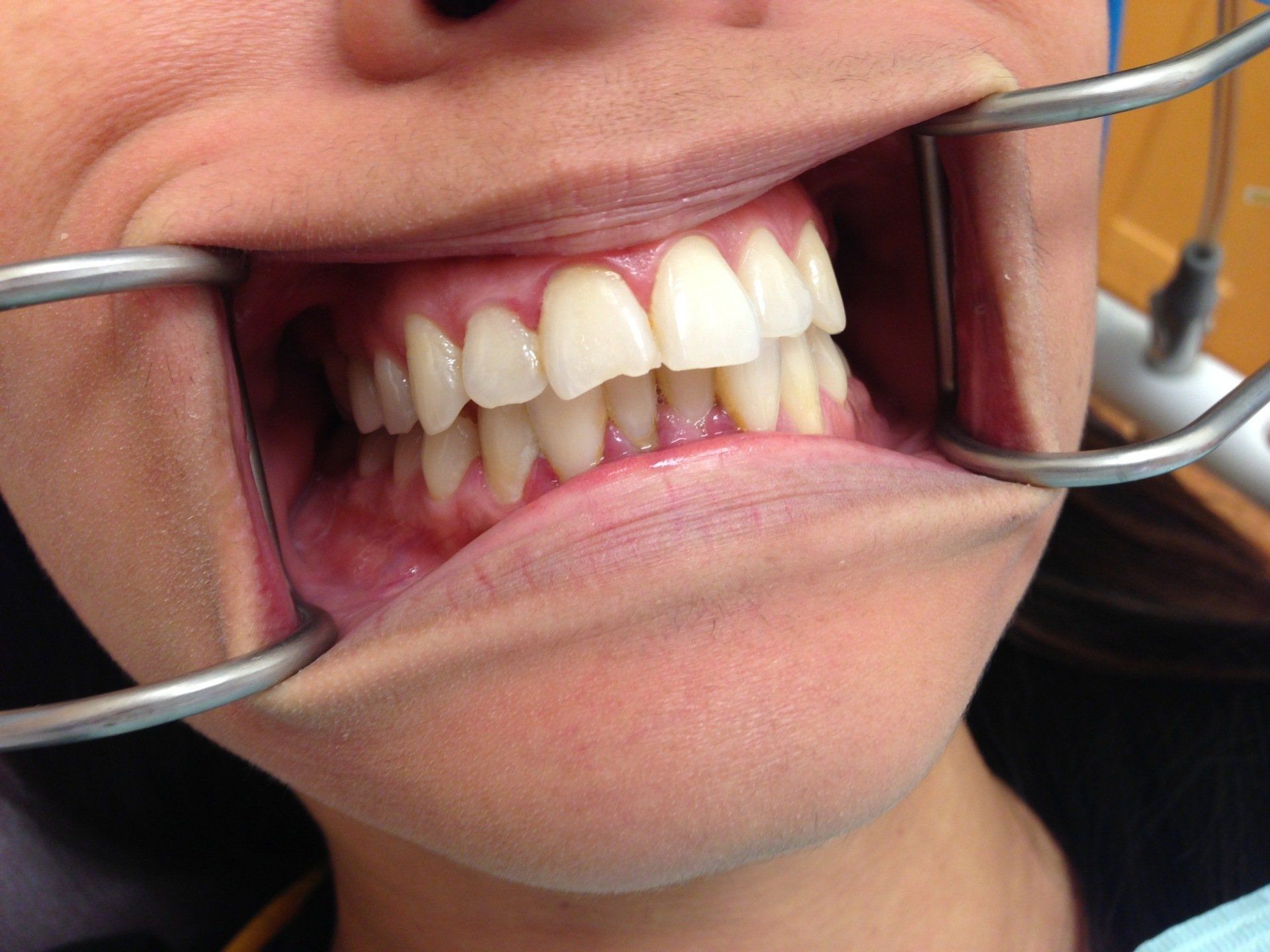 A woman is getting her teeth examined by a dentist