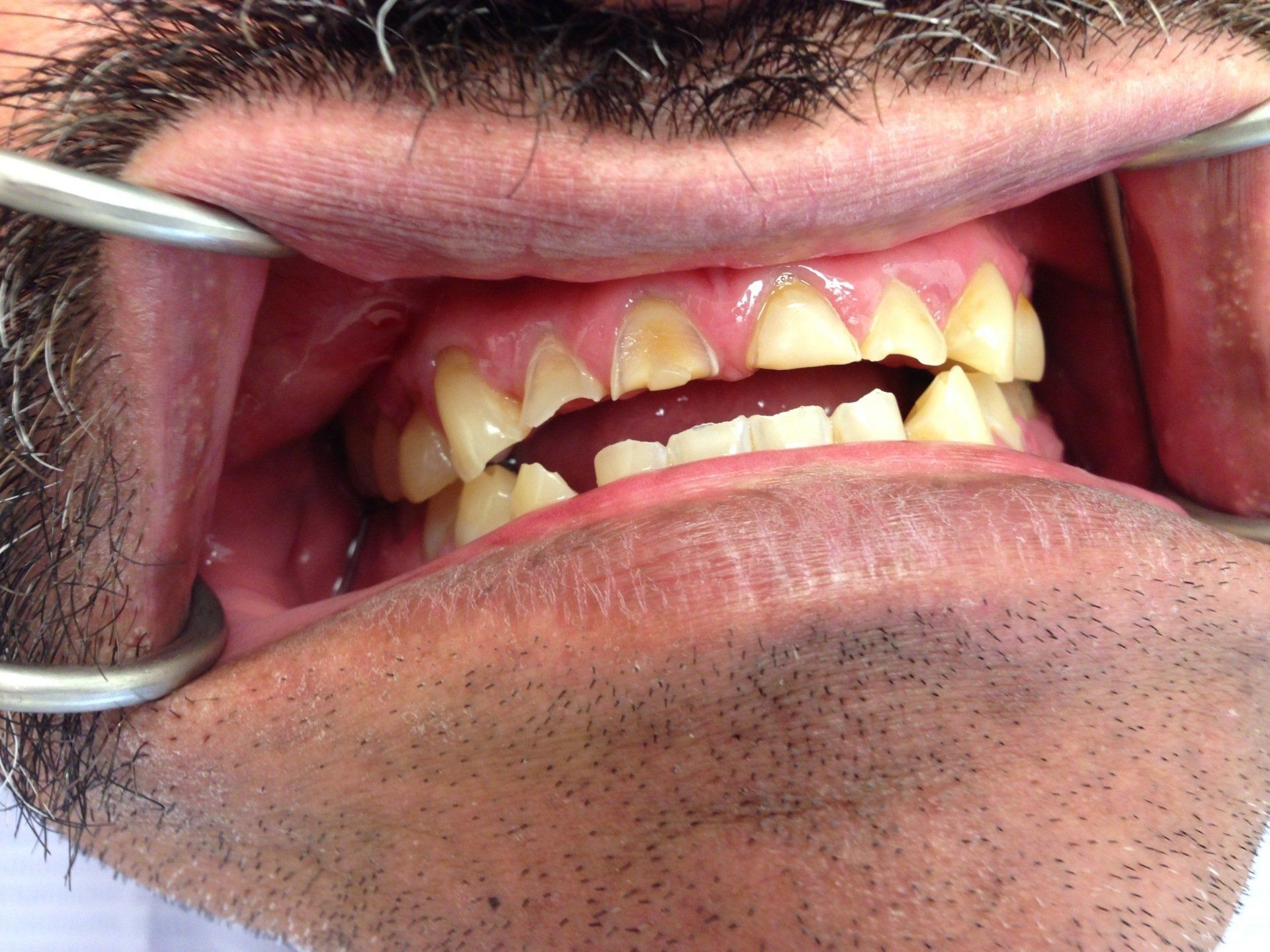 A man with a beard is getting his teeth examined by a dentist