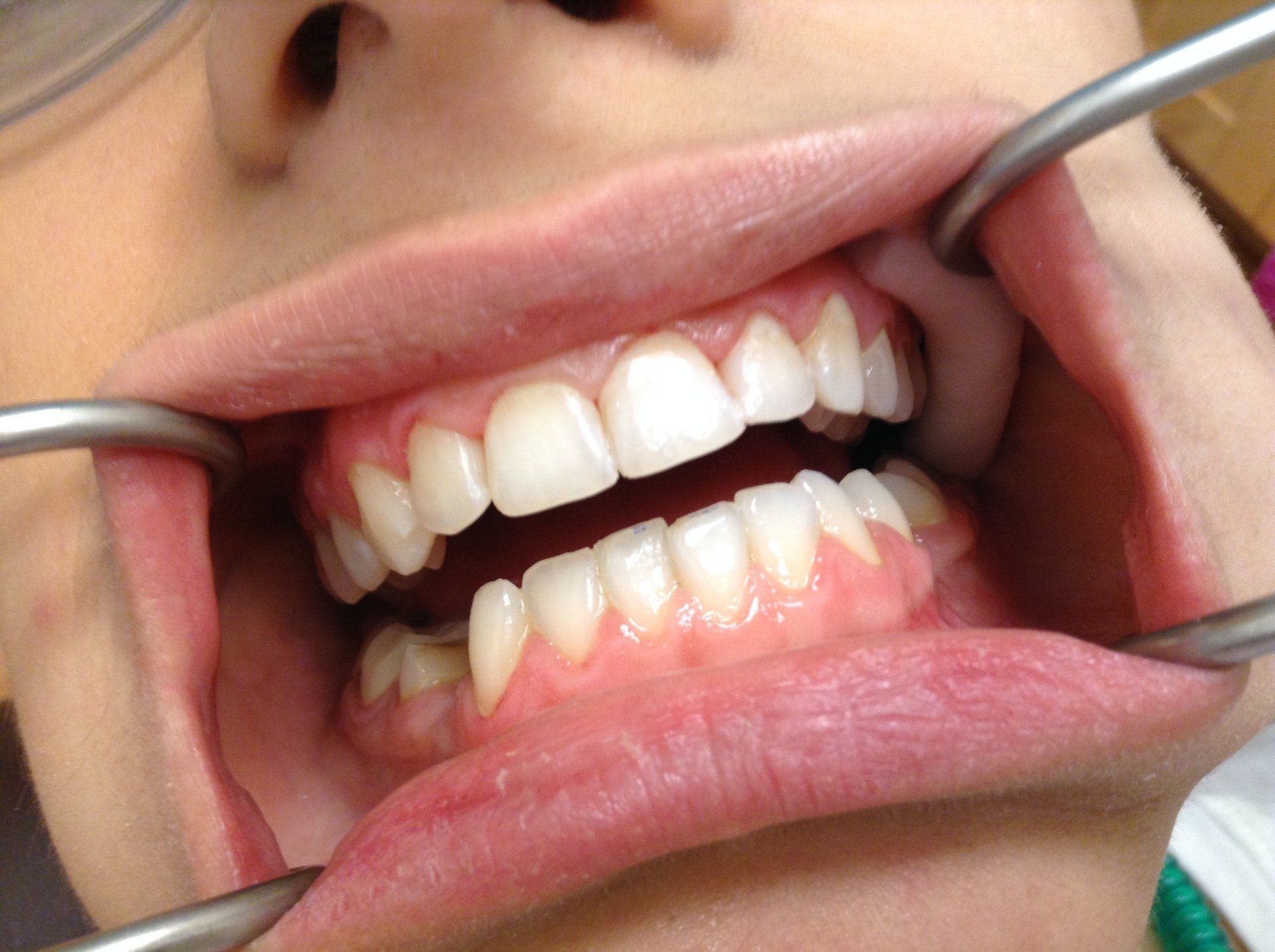 A close up of a person 's teeth being examined by a dentist