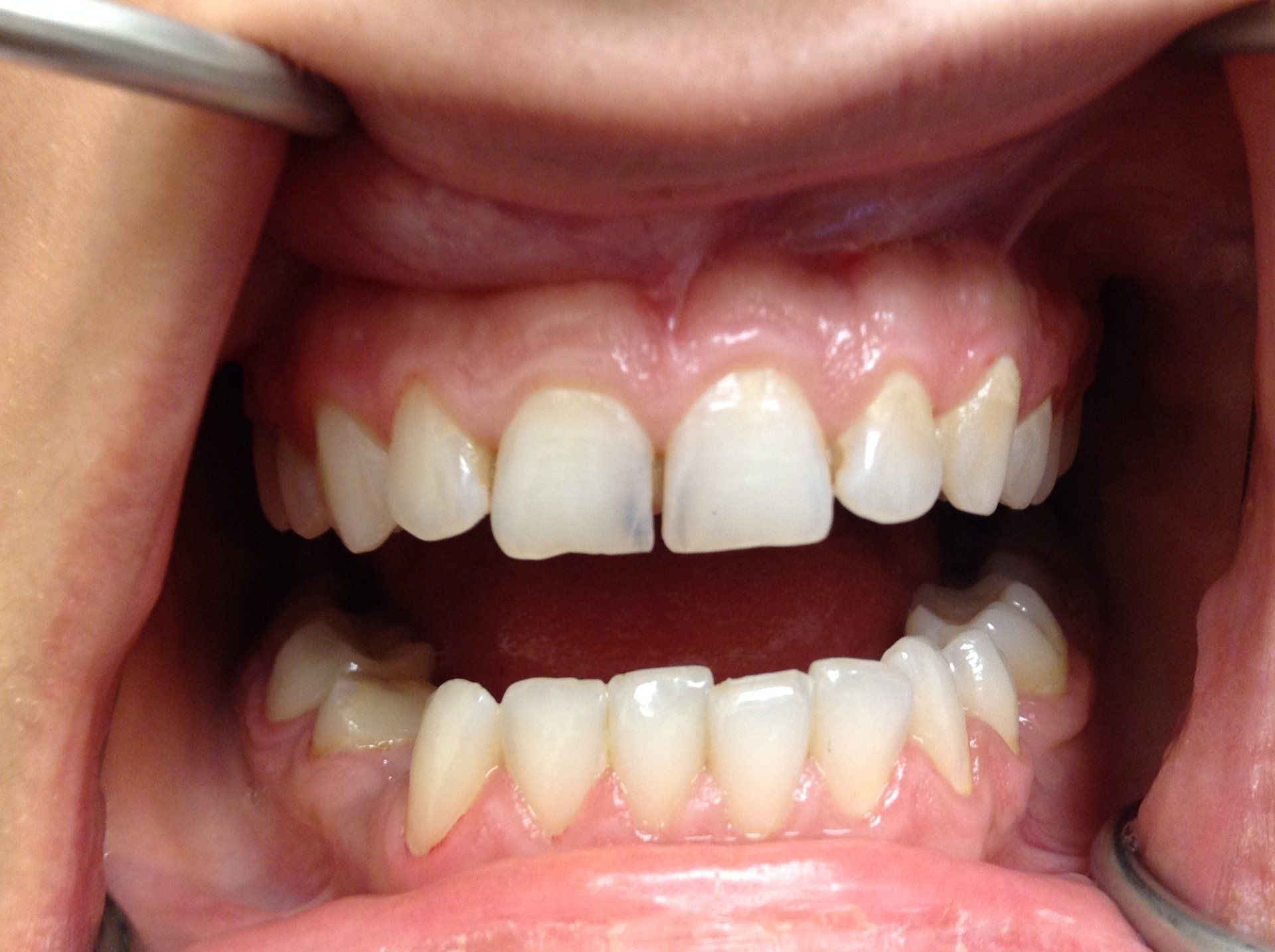 A close up of a person 's teeth with a dental mirror.