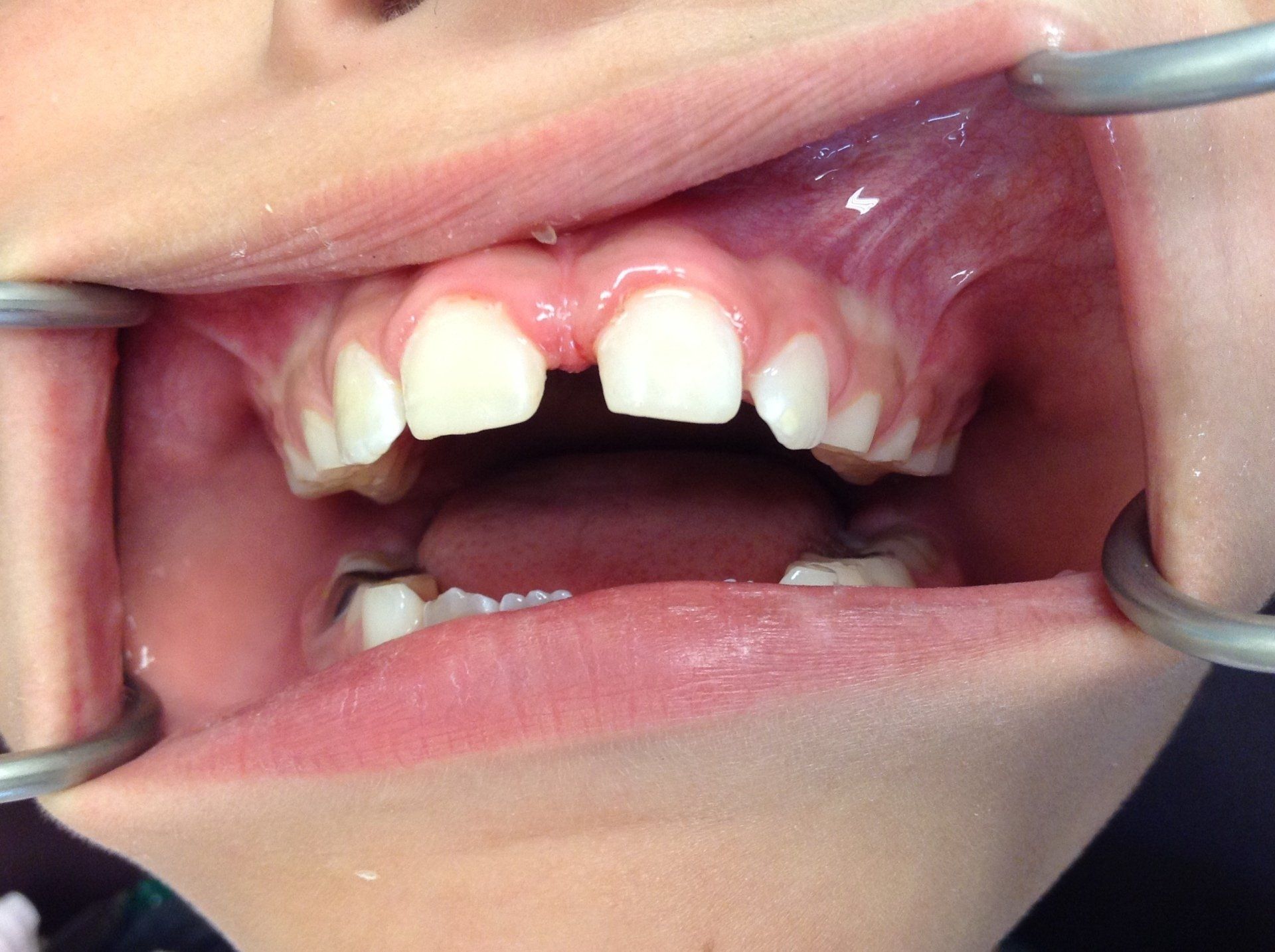 A close up of a person 's mouth with a tooth missing.