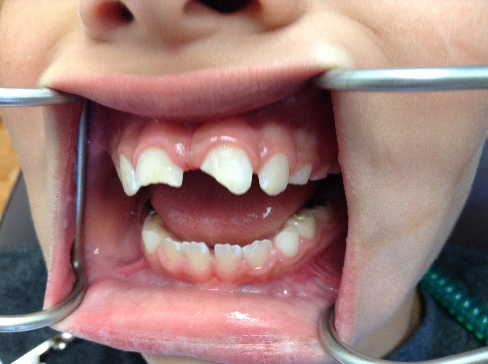A close up of a child 's mouth with a broken tooth