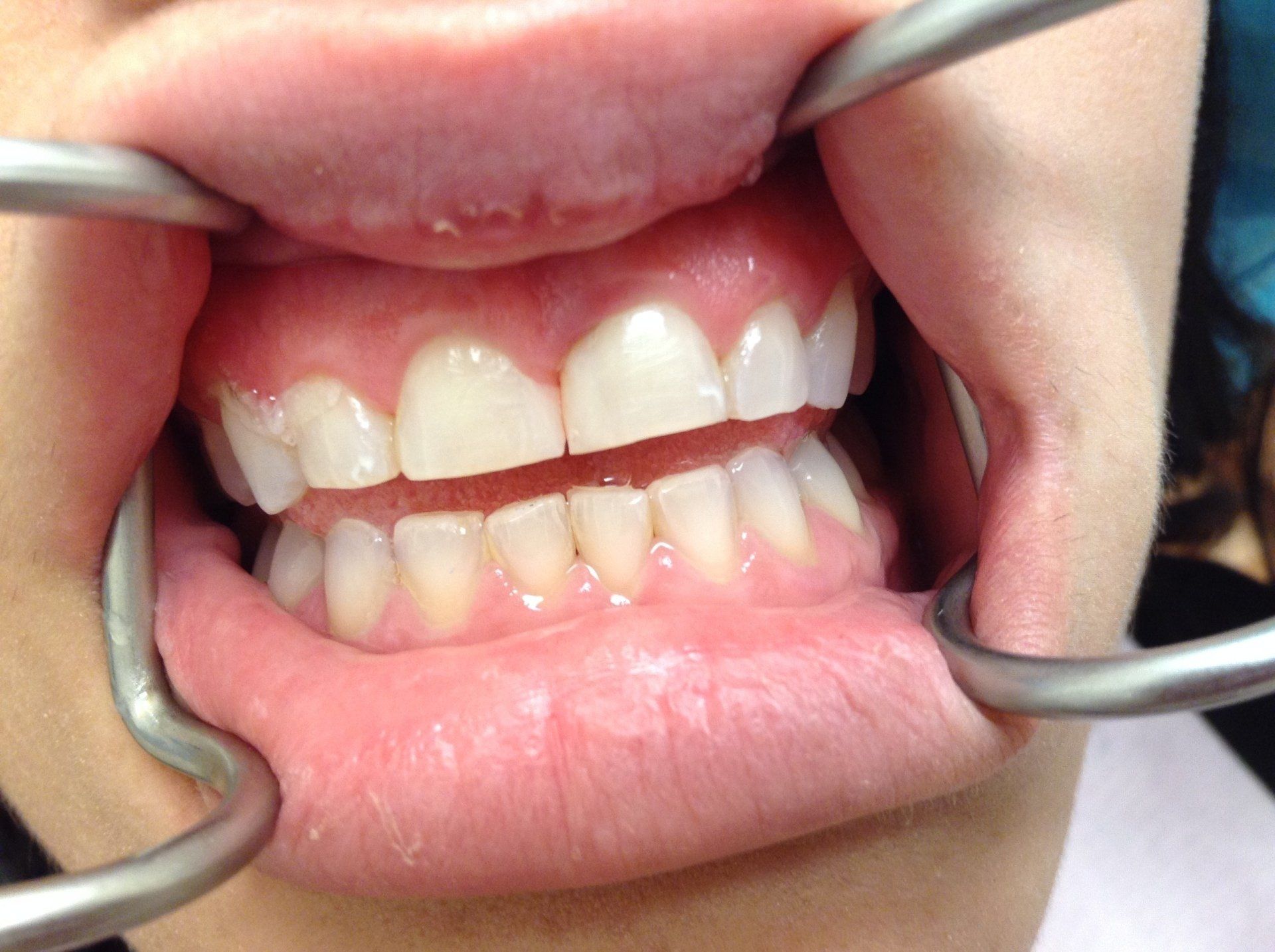 A close up of a person 's mouth with a metal device in it.
