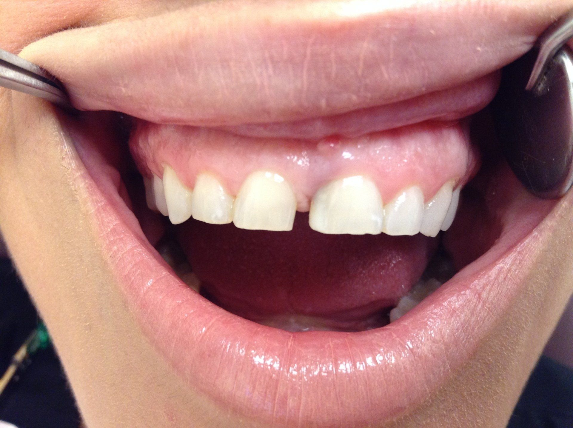 A close up of a woman 's mouth with a tooth missing.