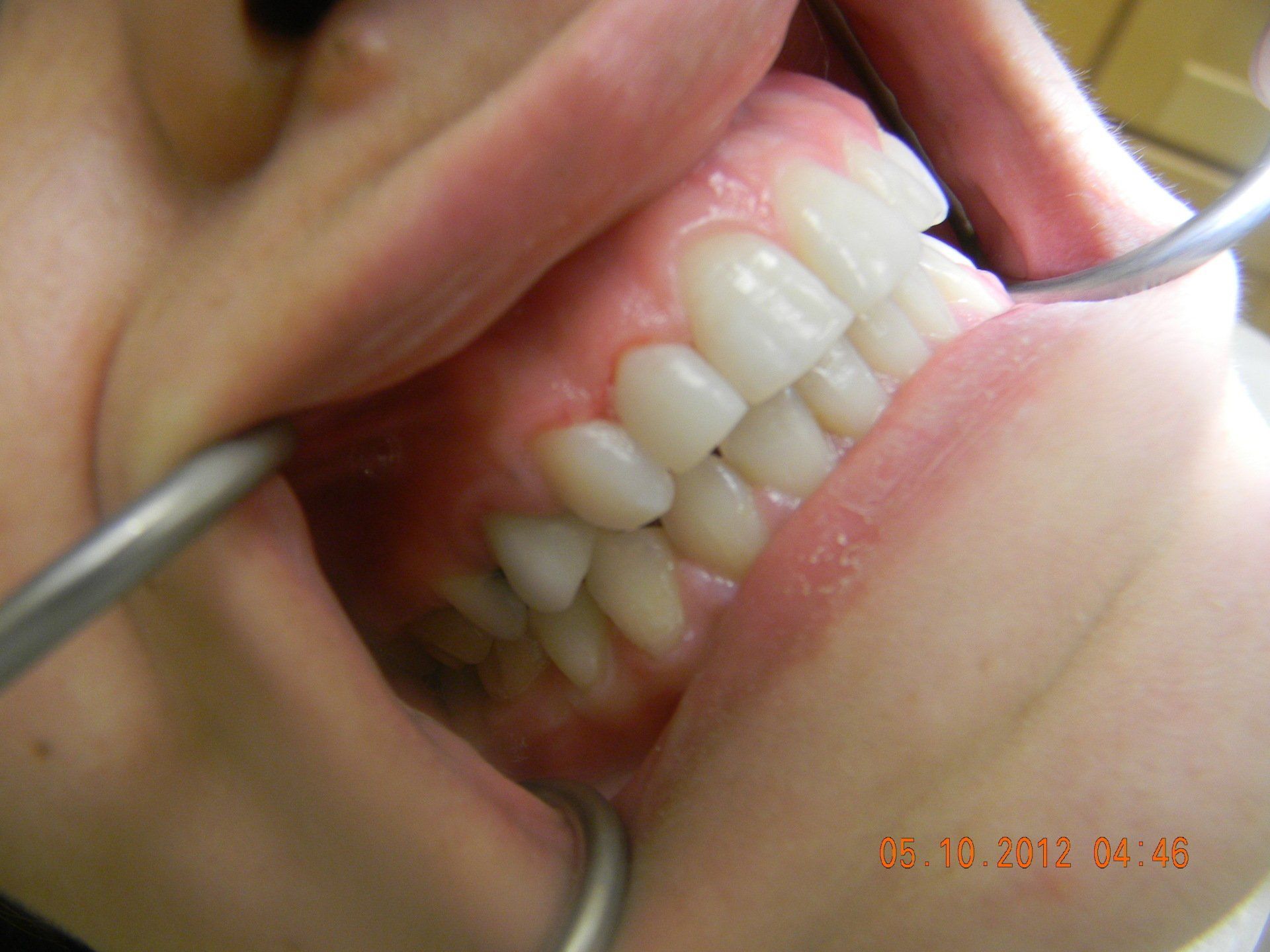 A close up of a person 's teeth with a dental mirror.
