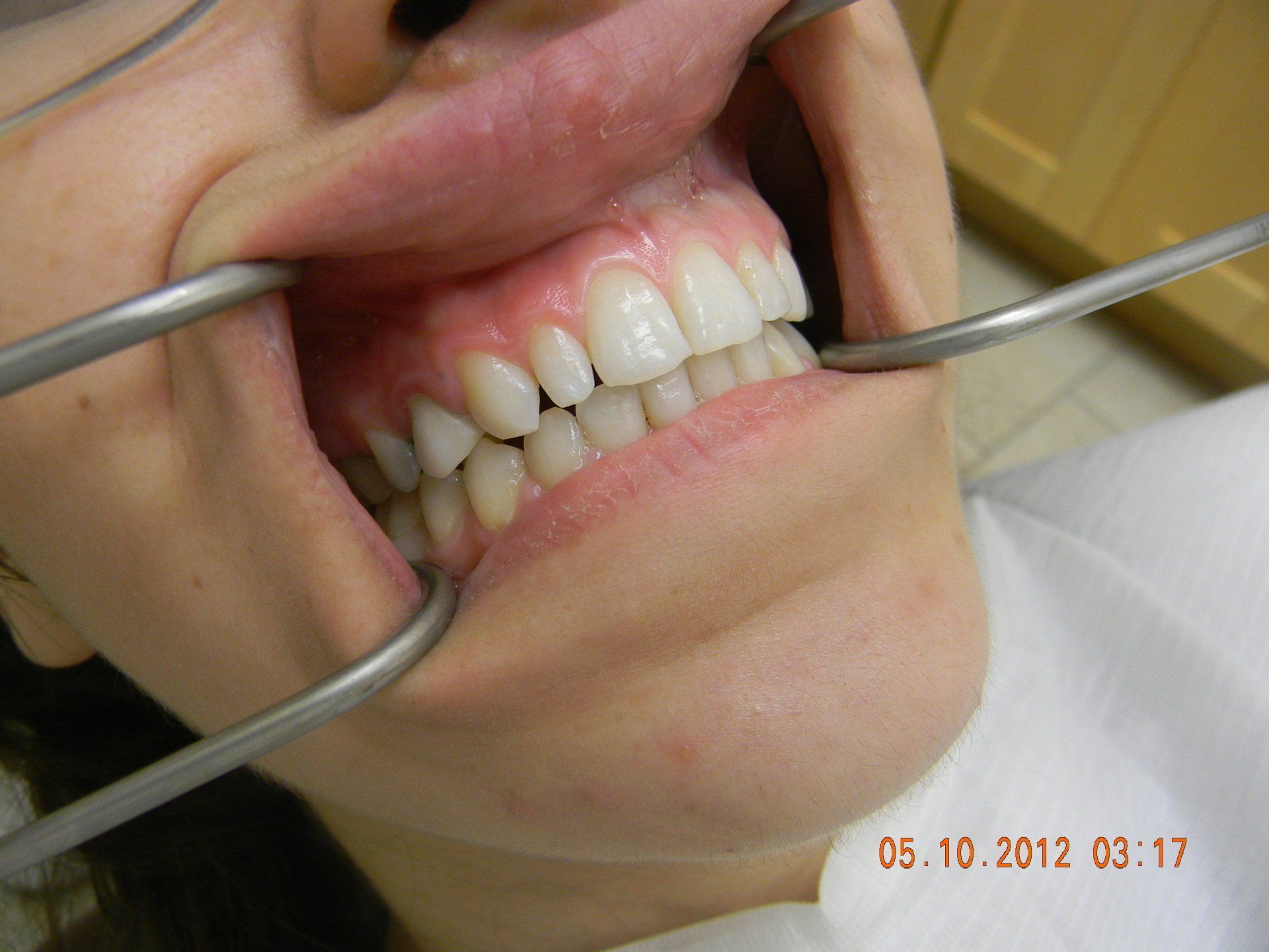 A woman is getting her teeth examined by a dentist.
