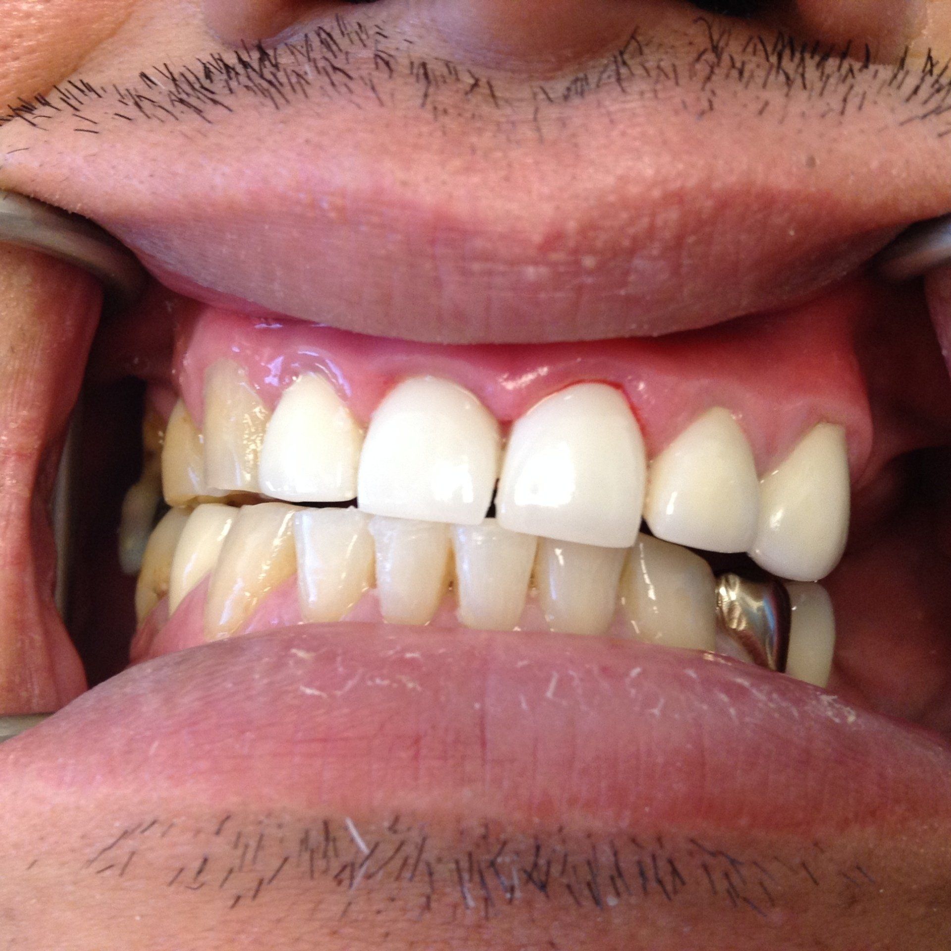 A close up of a person 's mouth with white teeth