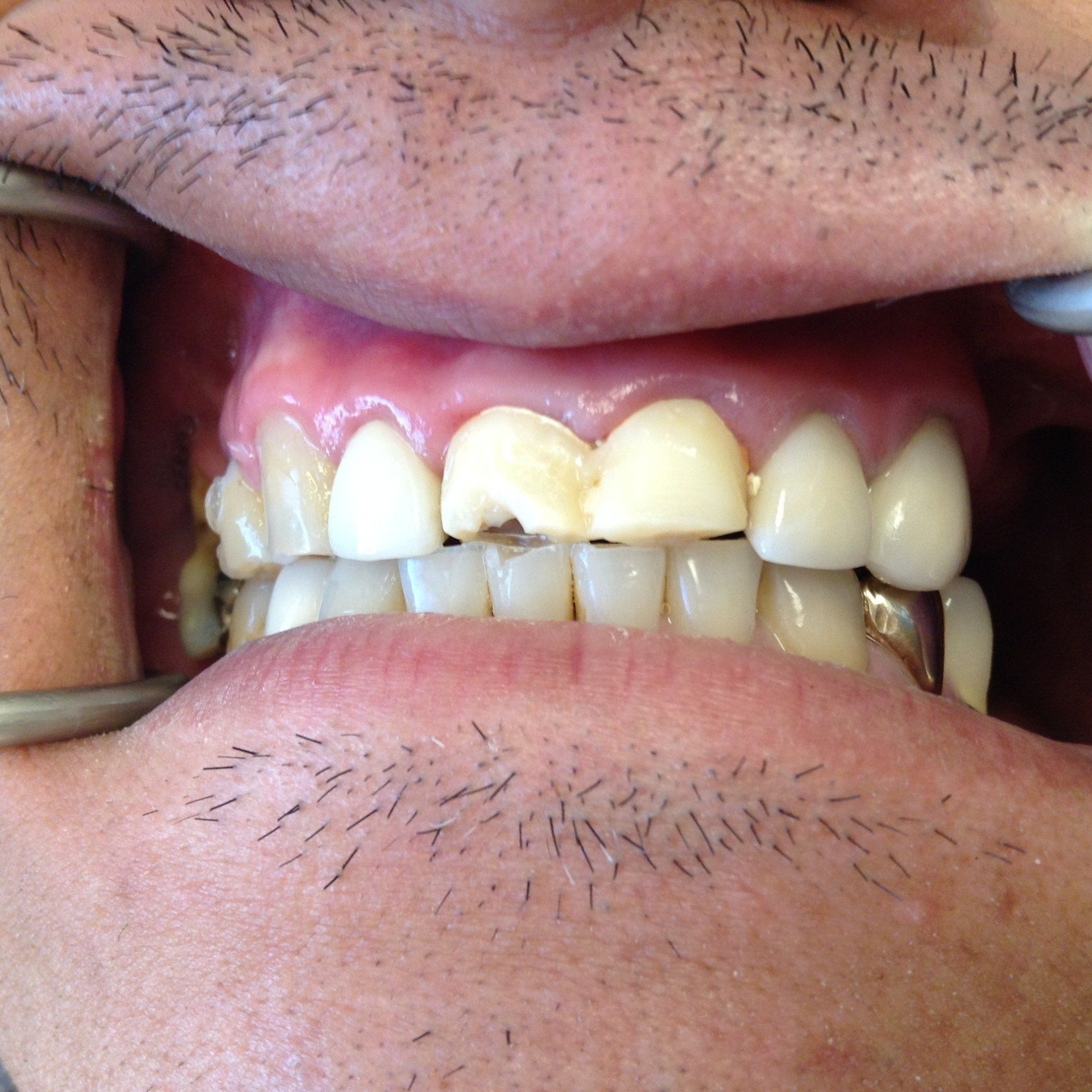 A close up of a man 's mouth with a broken tooth