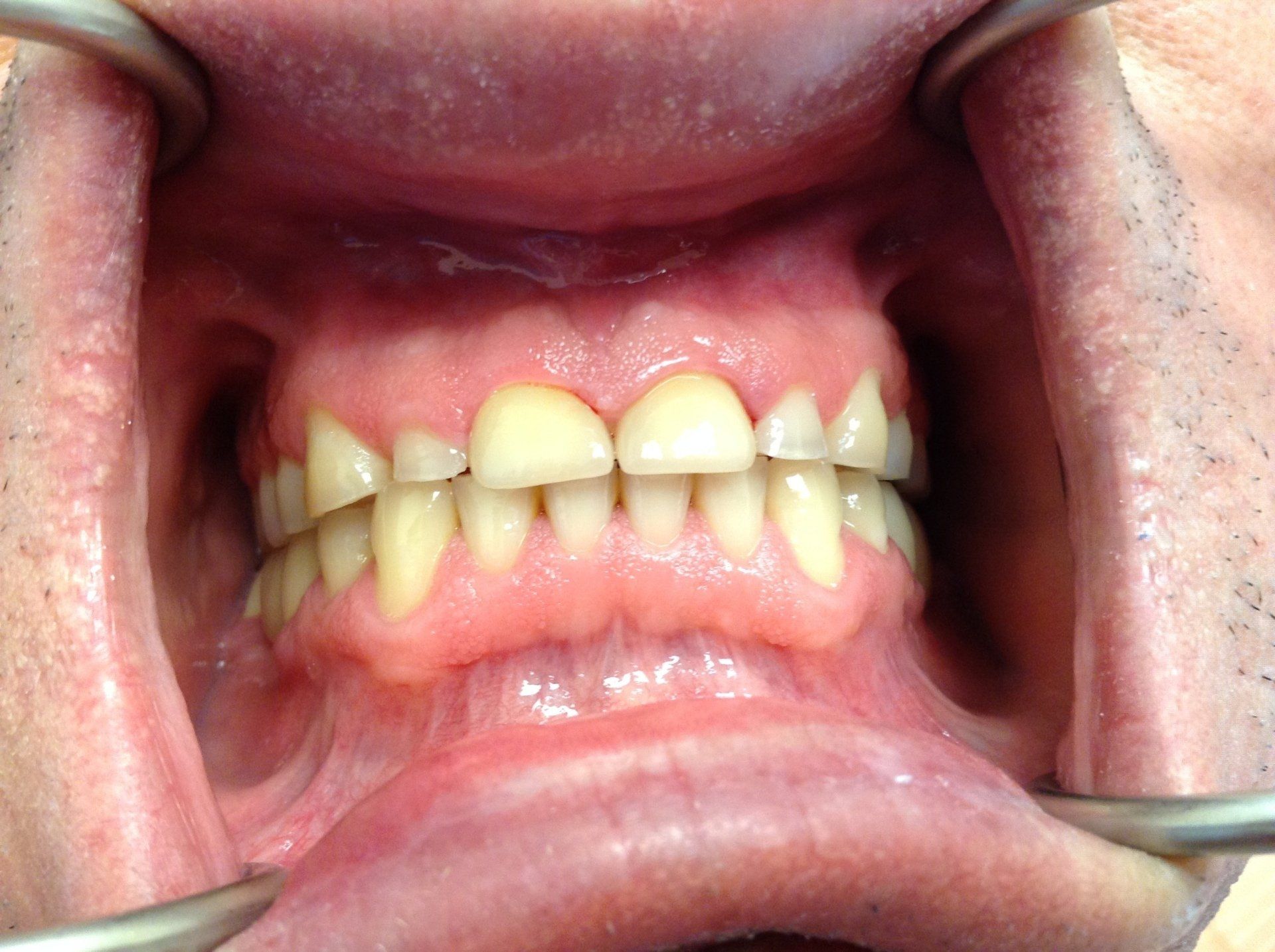 A close up of a person 's mouth with braces on their teeth.