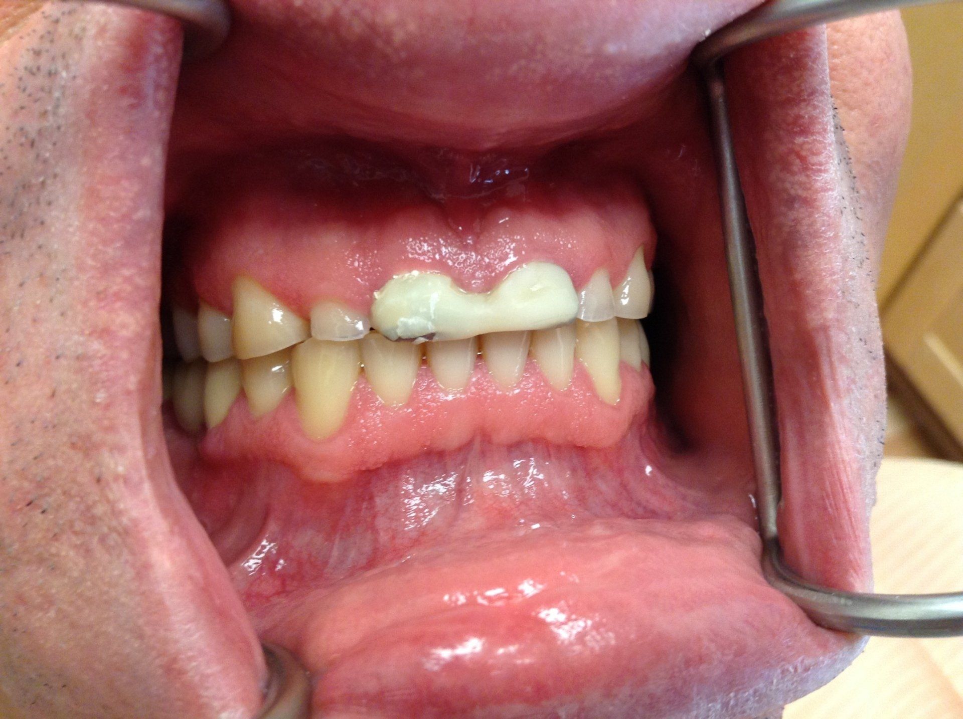 A close up of a person 's mouth with a broken tooth.