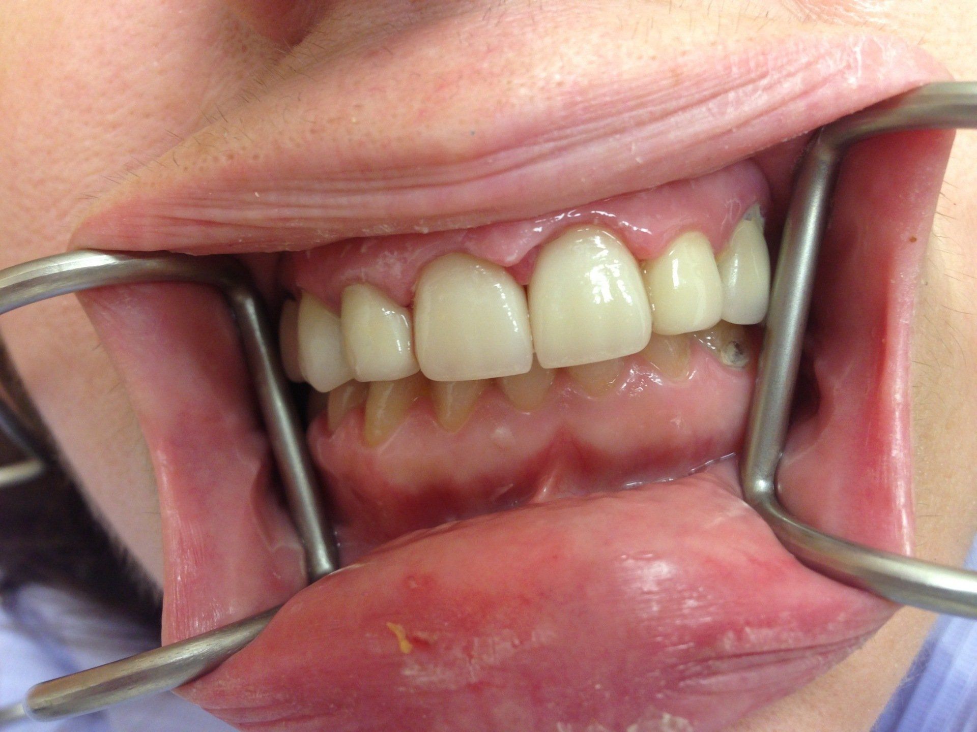 A close up of a person 's mouth with braces on their teeth.