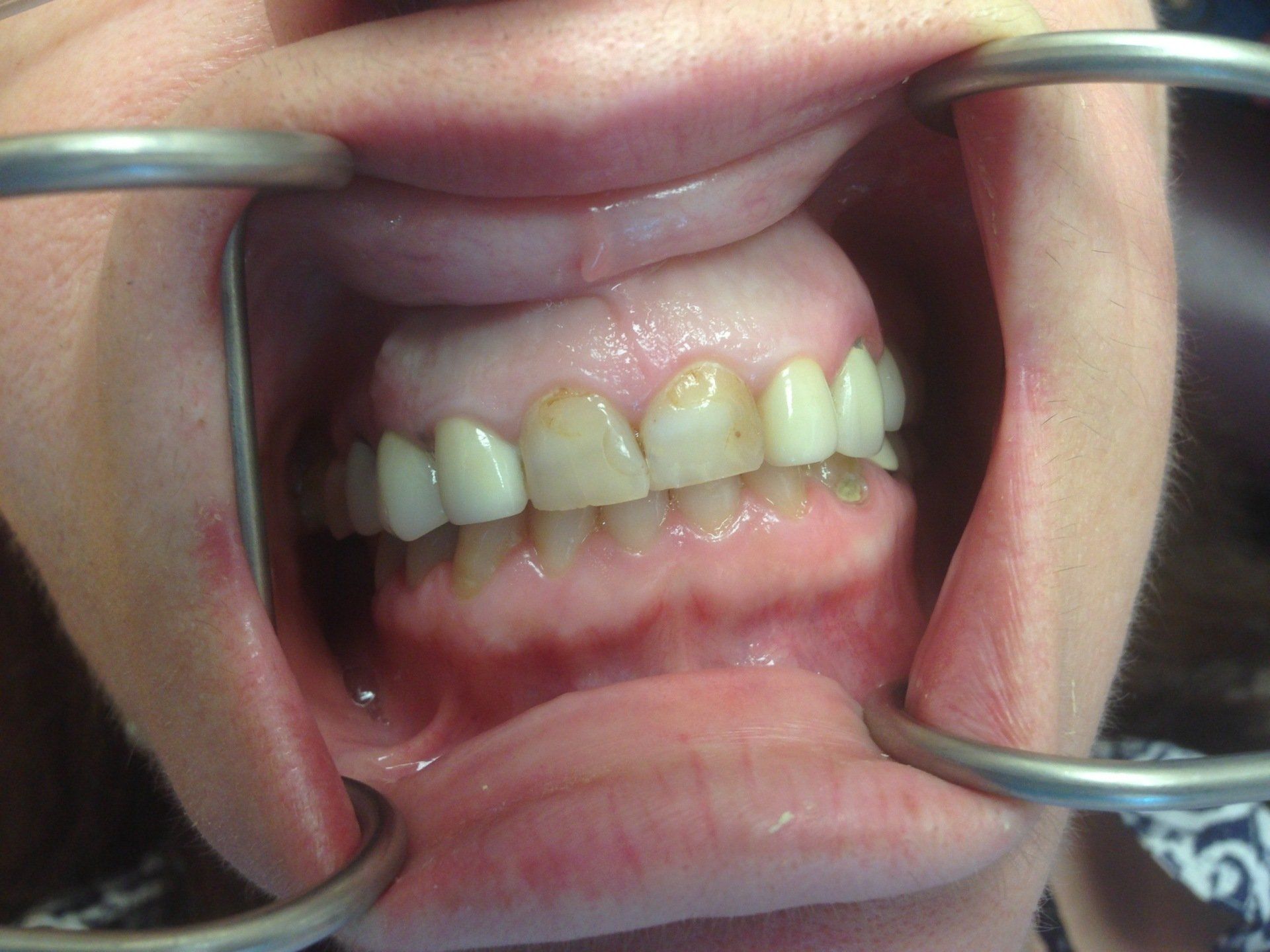 A close up of a person 's mouth with braces on their teeth.