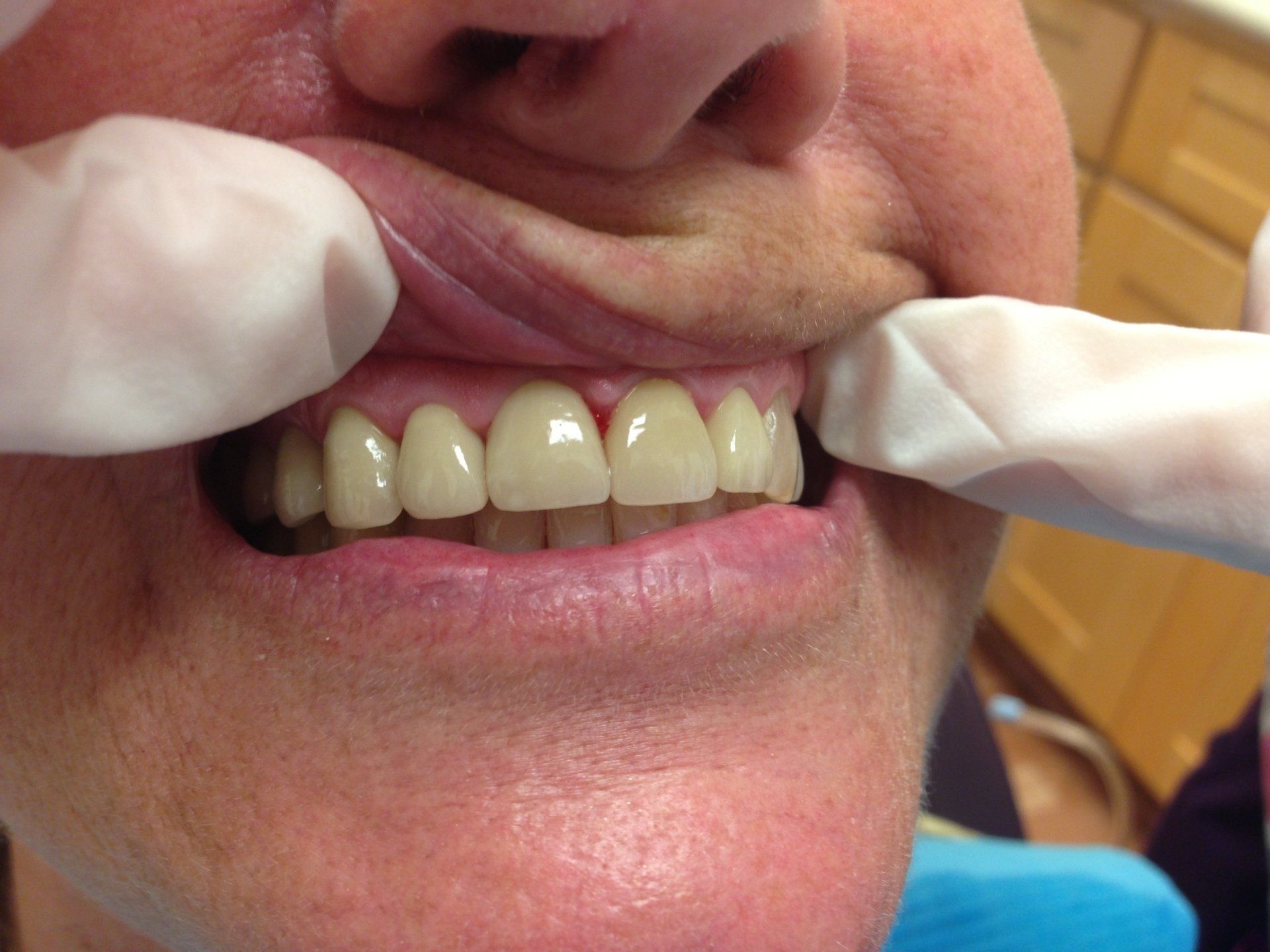 A close up of a person 's teeth with gloves on.