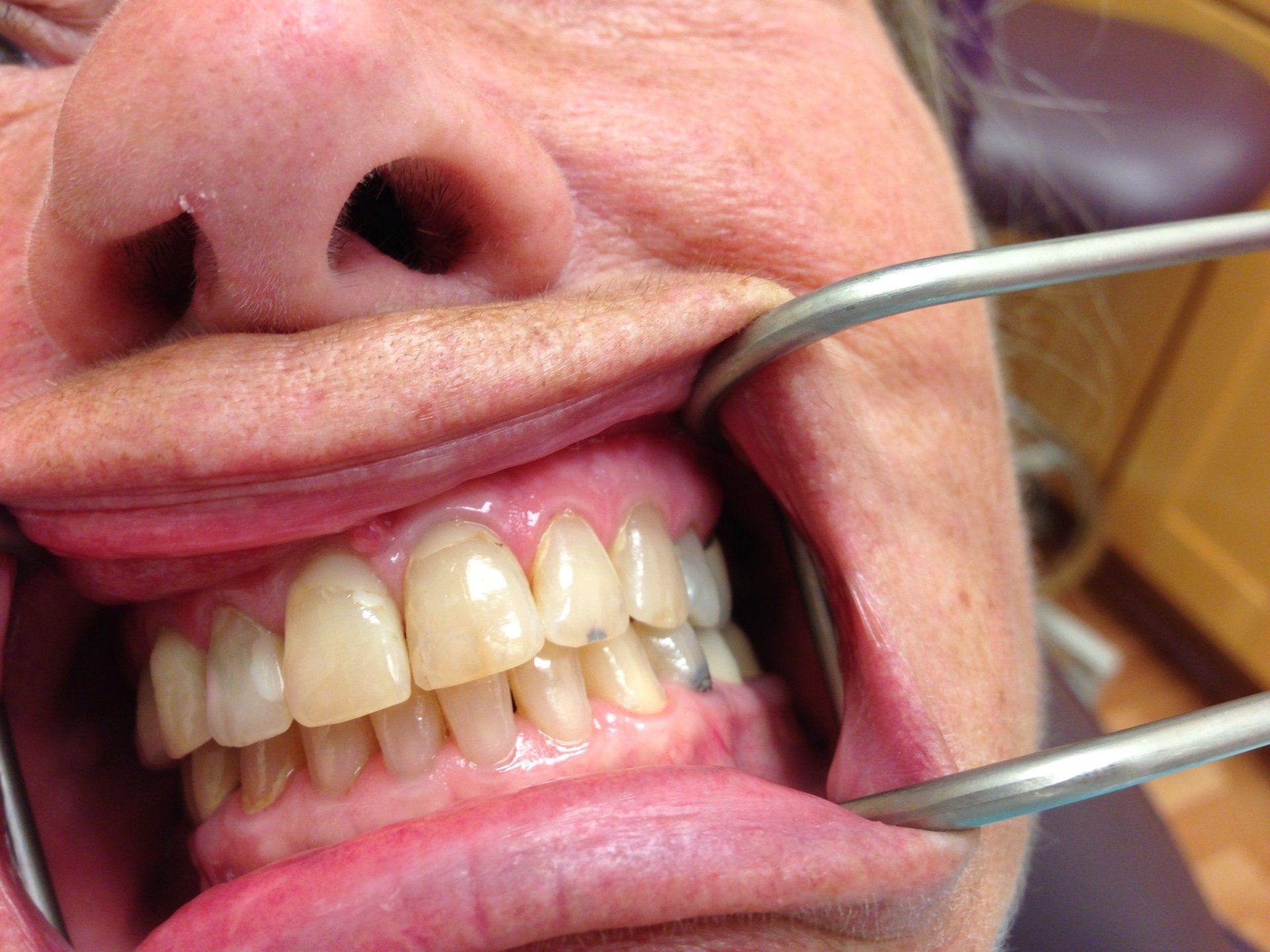 A woman is getting her teeth examined by a dentist.