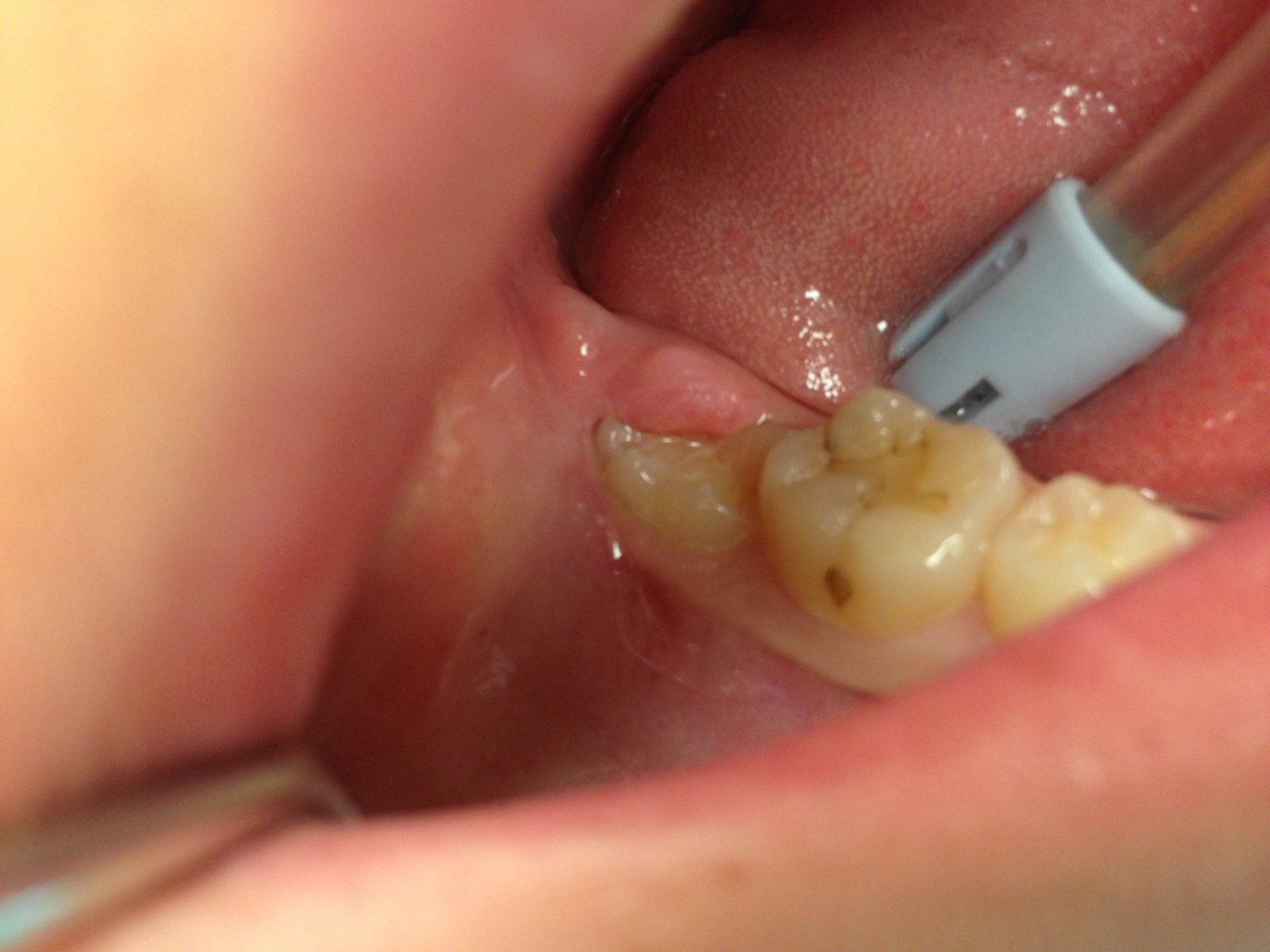 A close up of a person 's mouth with a syringe in it.