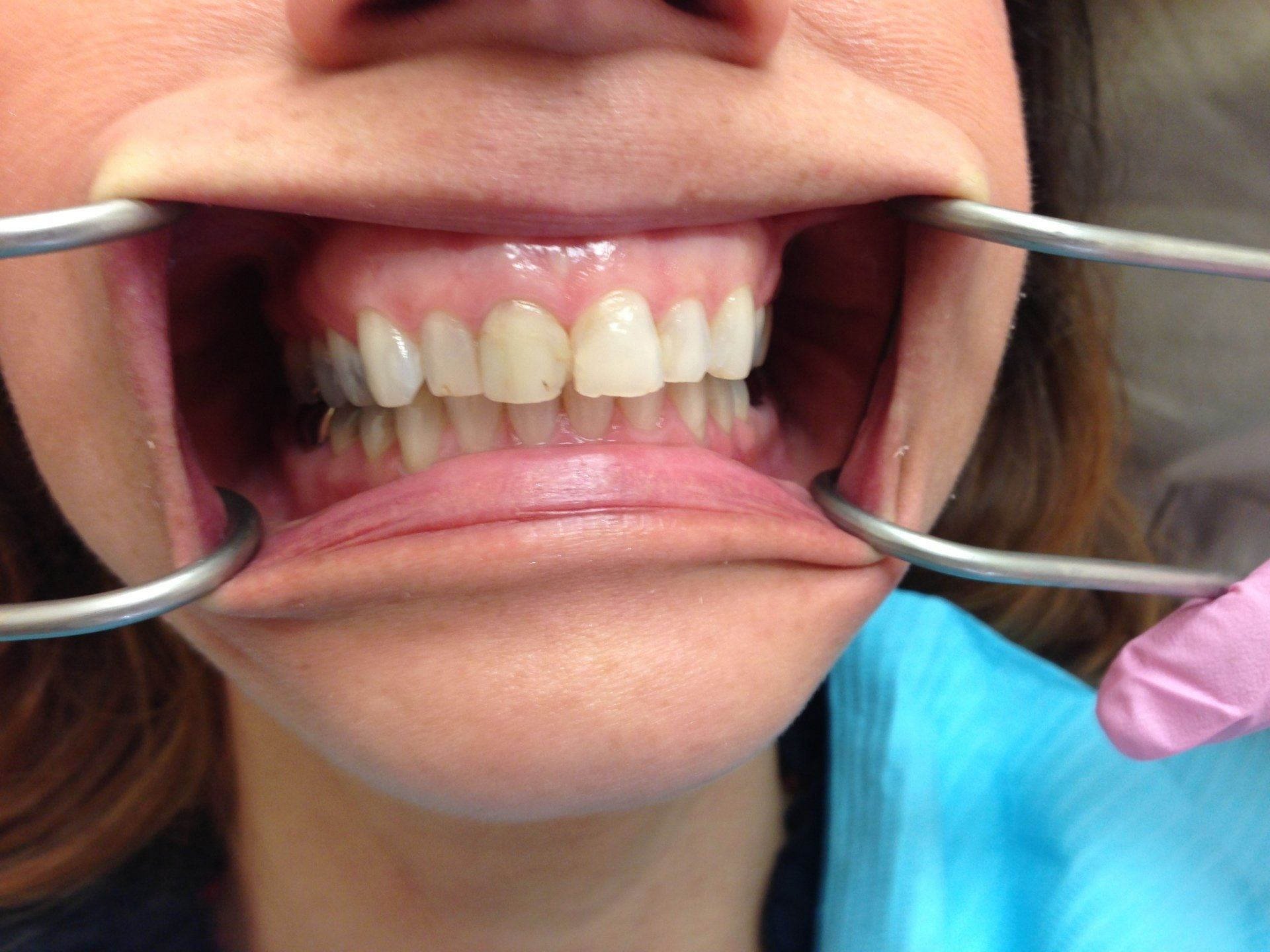 A woman is getting her teeth examined by a dentist.