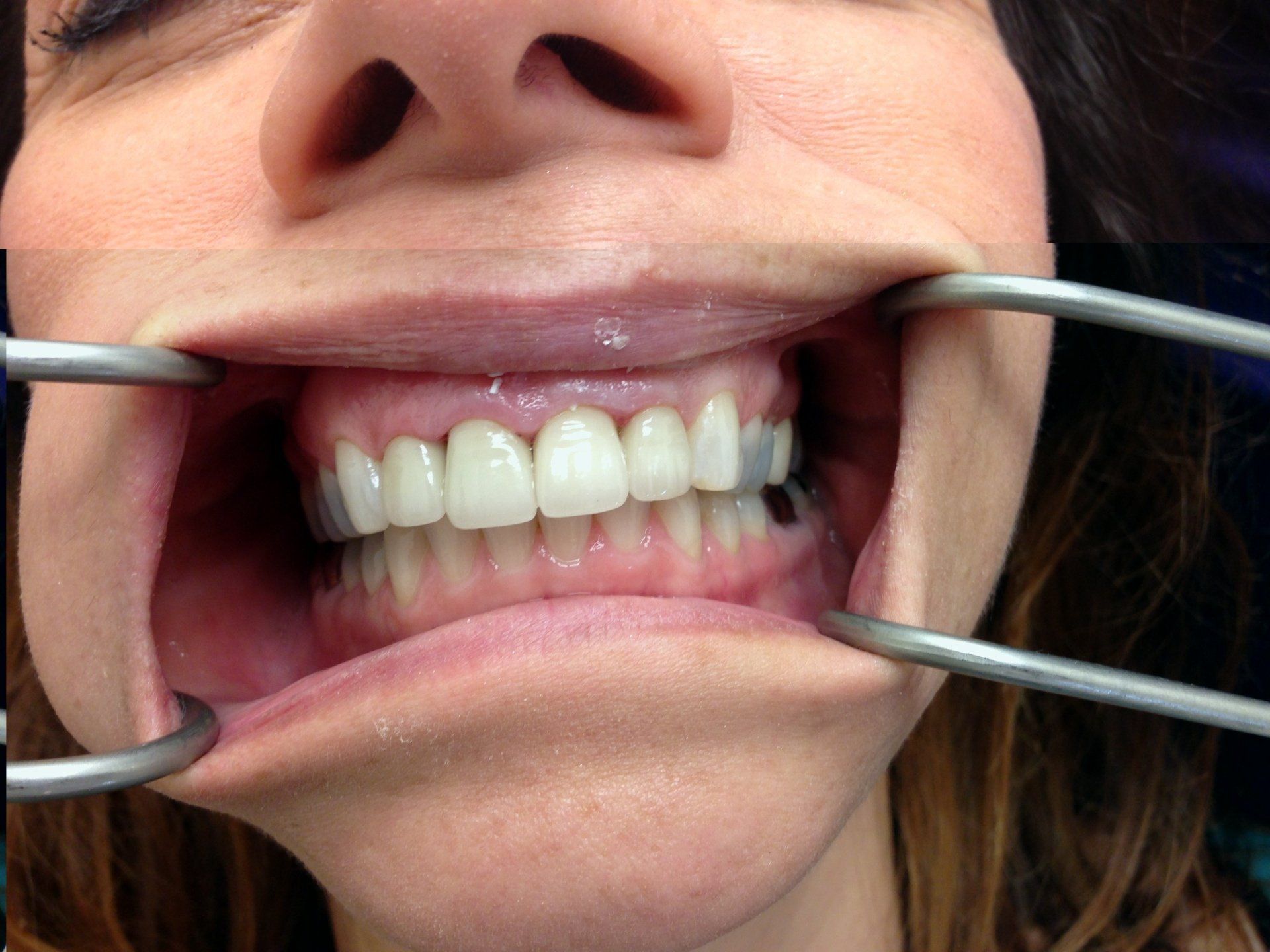 A close up of a woman 's mouth with braces on her teeth.