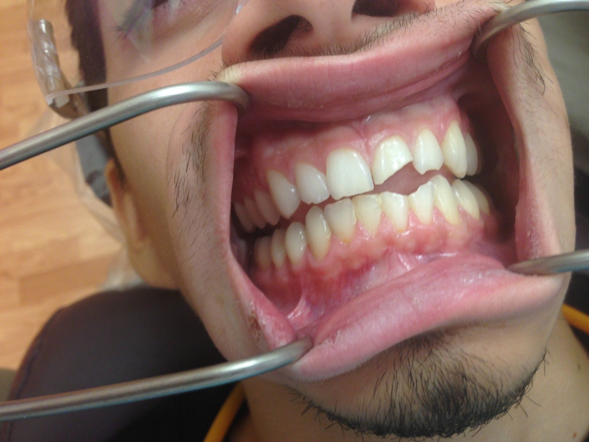 A man is getting his teeth examined by a dentist.