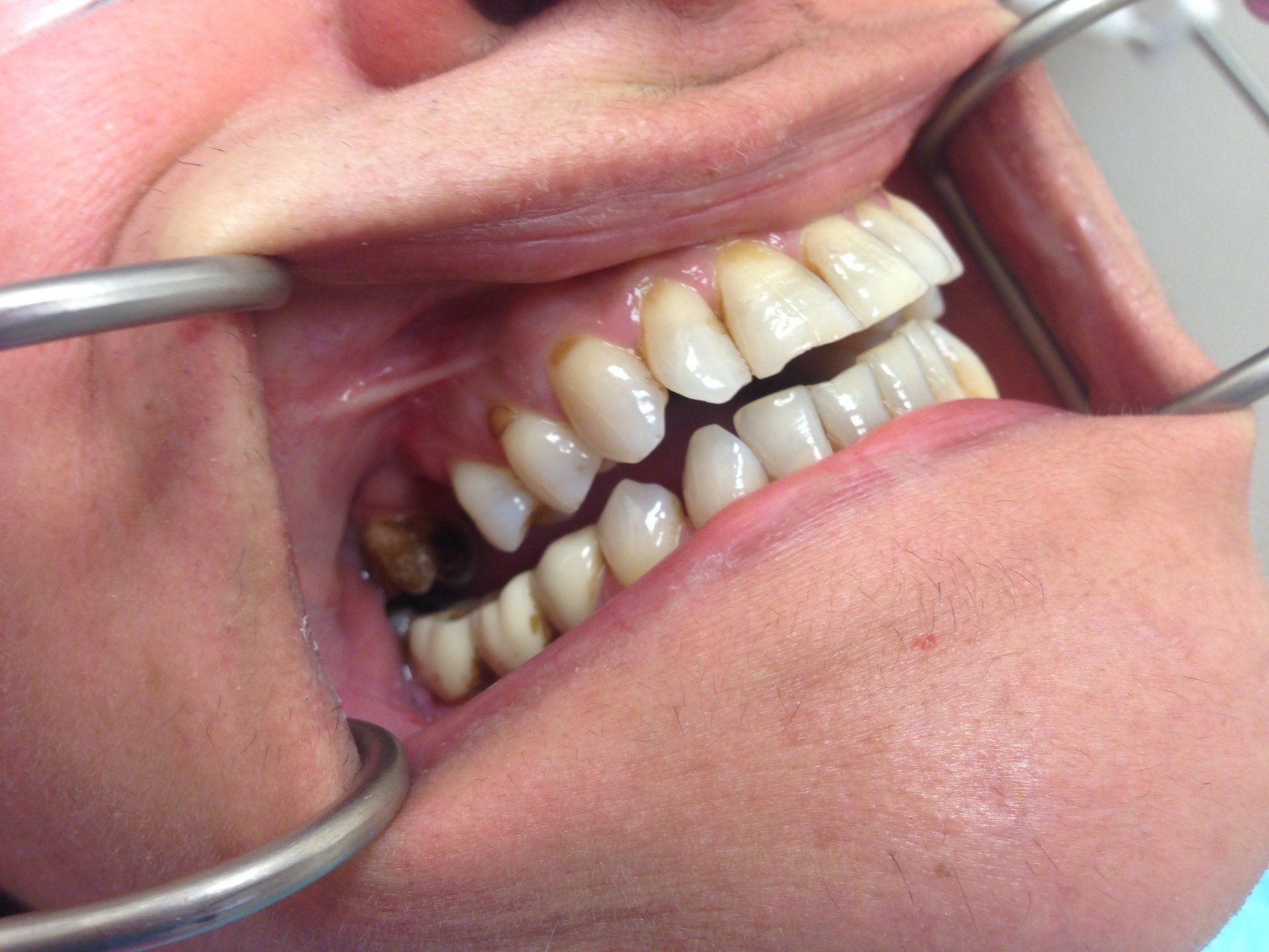 A close up of a person 's teeth being examined by a dentist