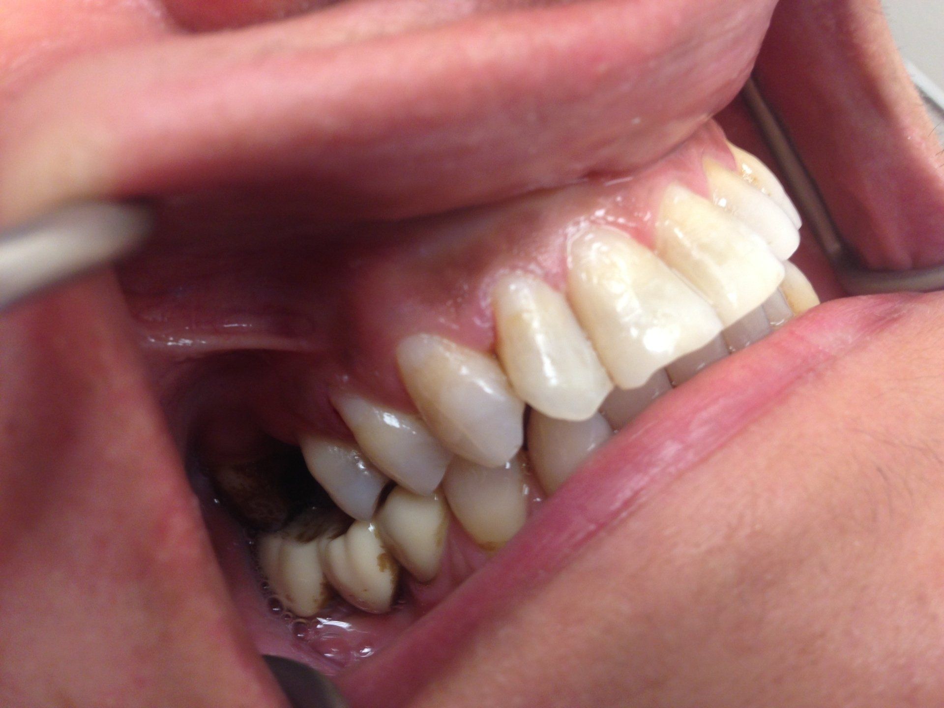 A close up of a person 's teeth with a dental mirror.