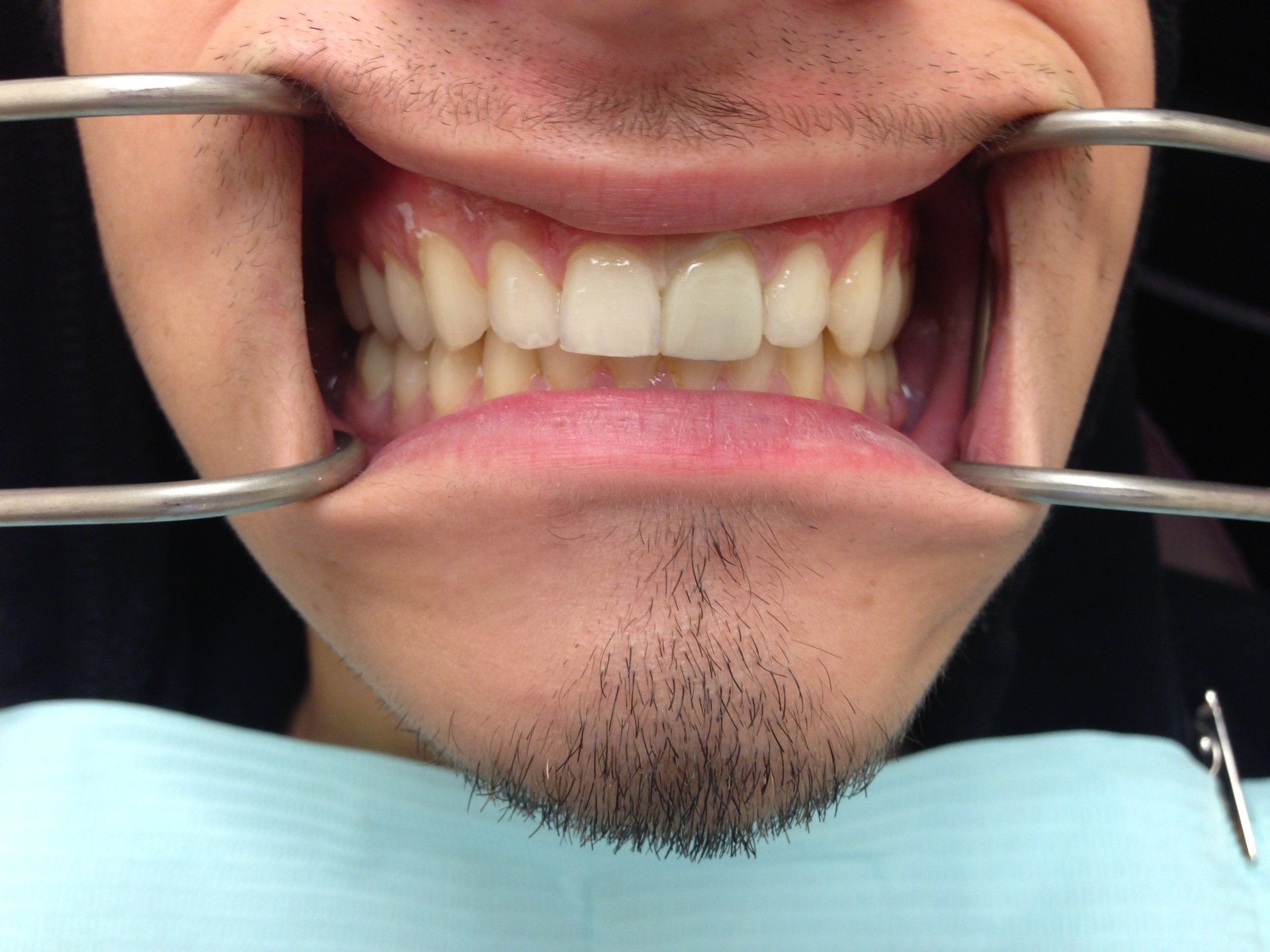 A man with a beard is getting his teeth examined by a dentist.