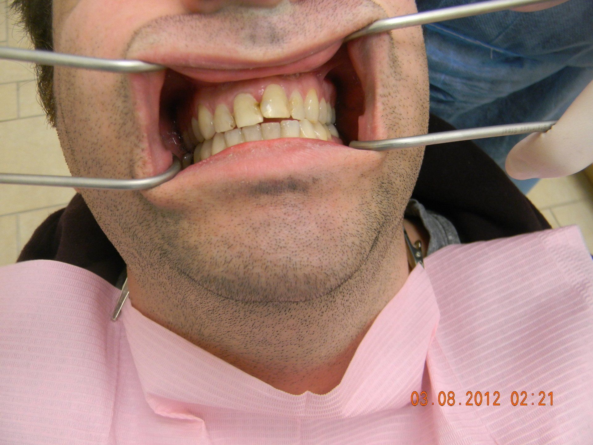 A man is getting his teeth examined by a dentist