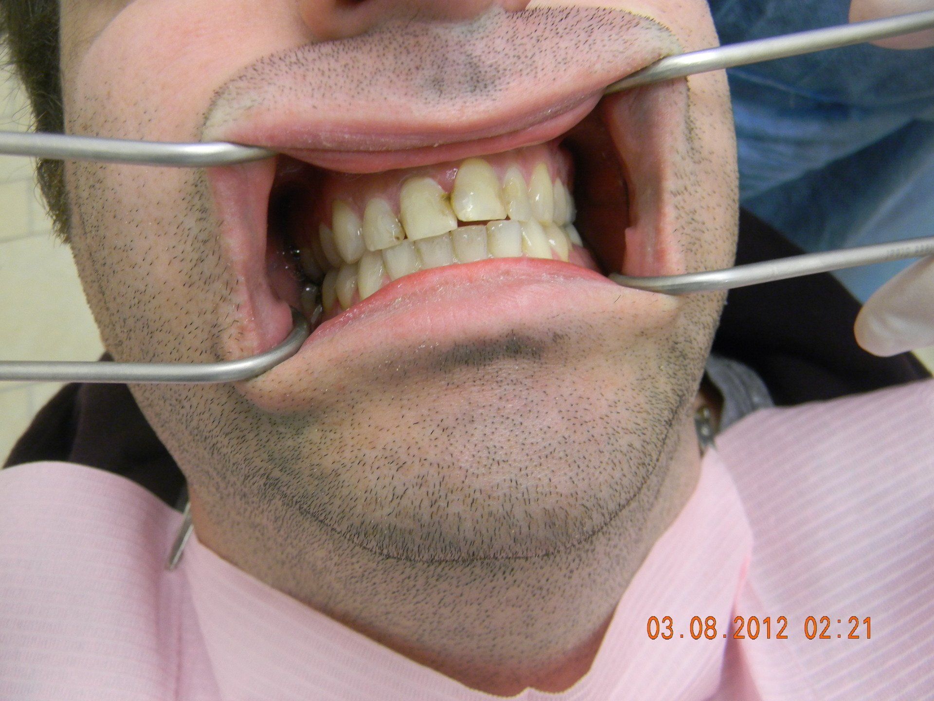 A man is getting his teeth examined by a dentist