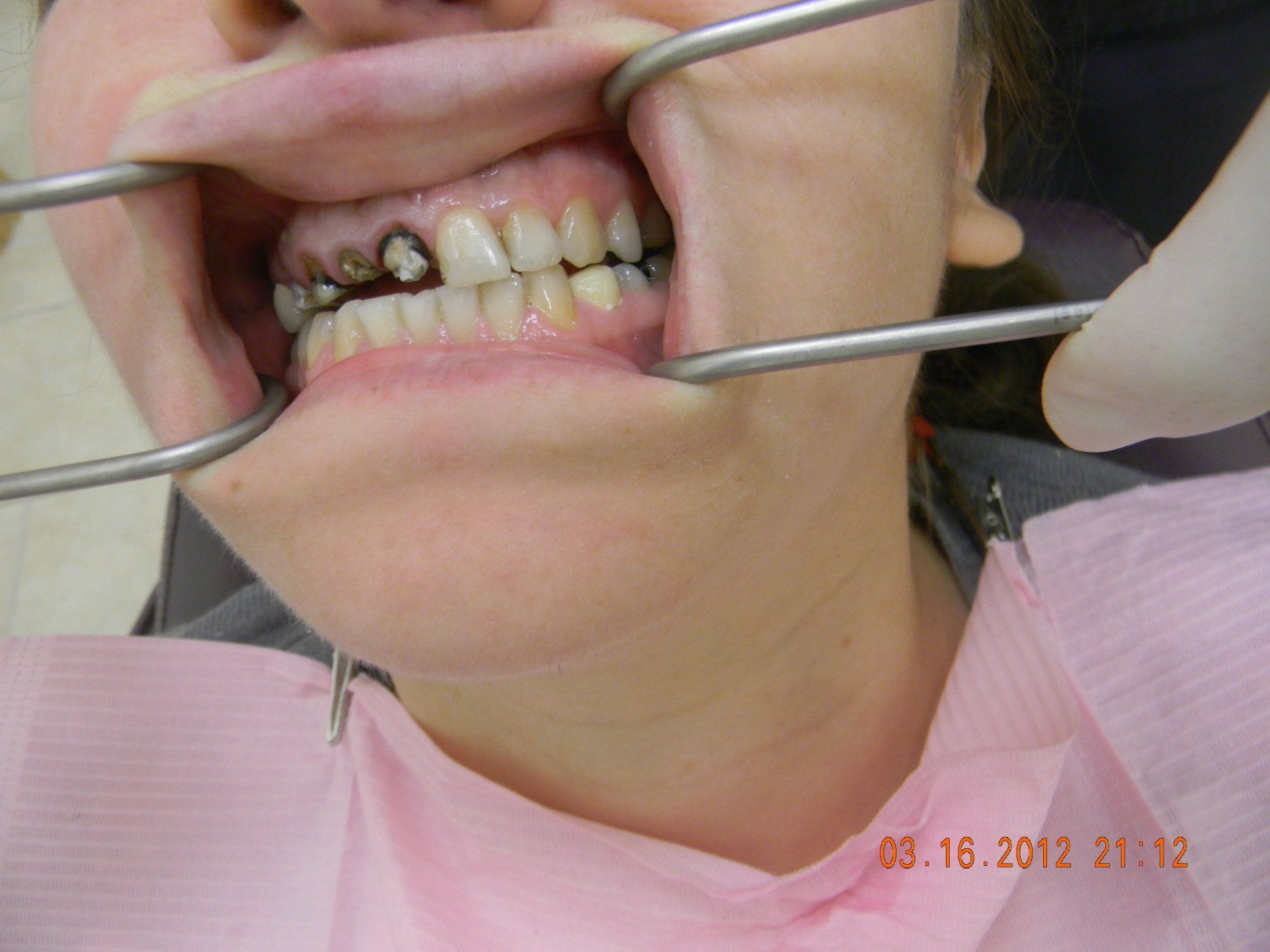 A woman is getting her teeth examined by a dentist.