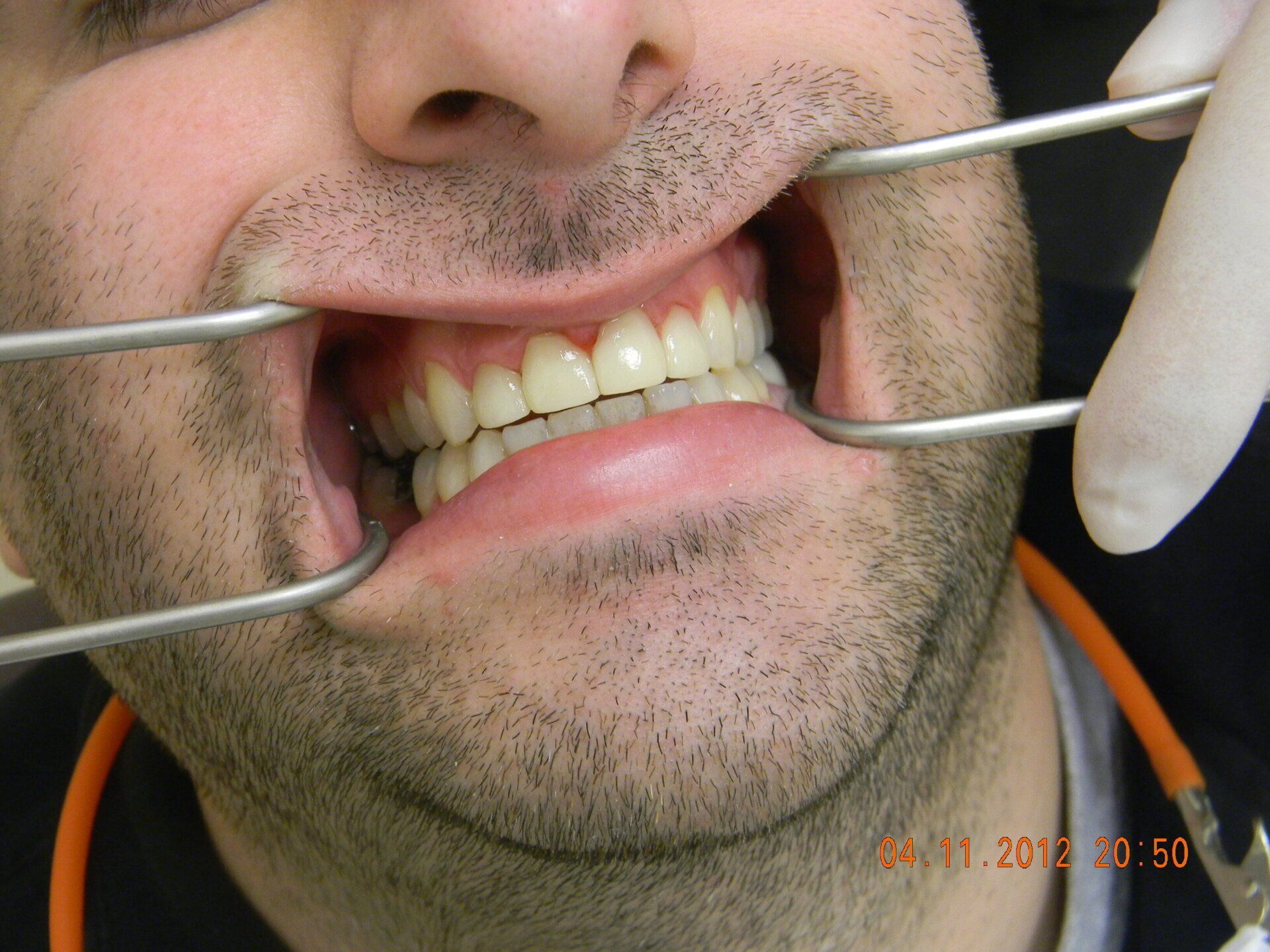 A man is getting his teeth examined by a dentist