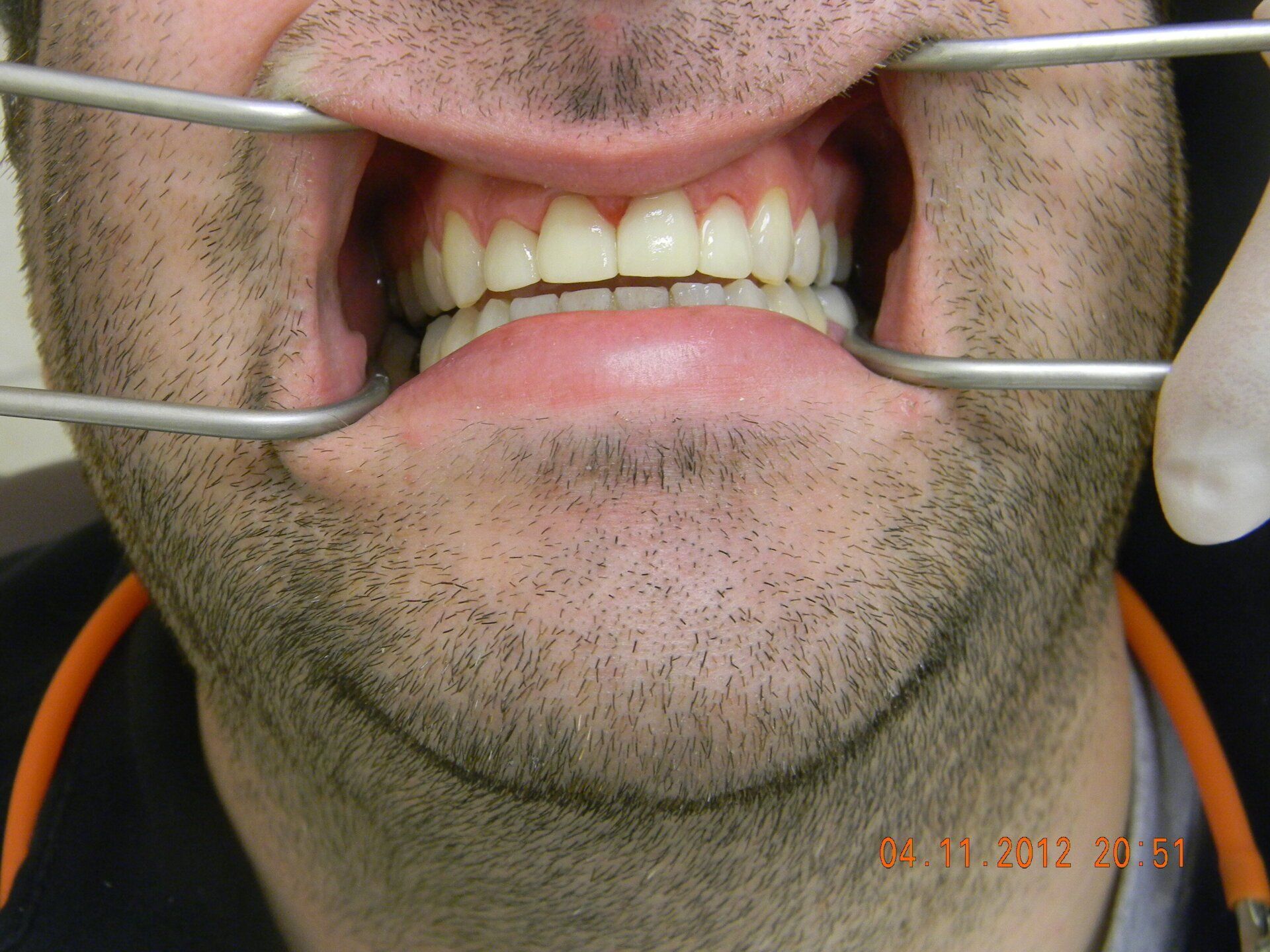 A man with a beard is getting his teeth examined by a dentist