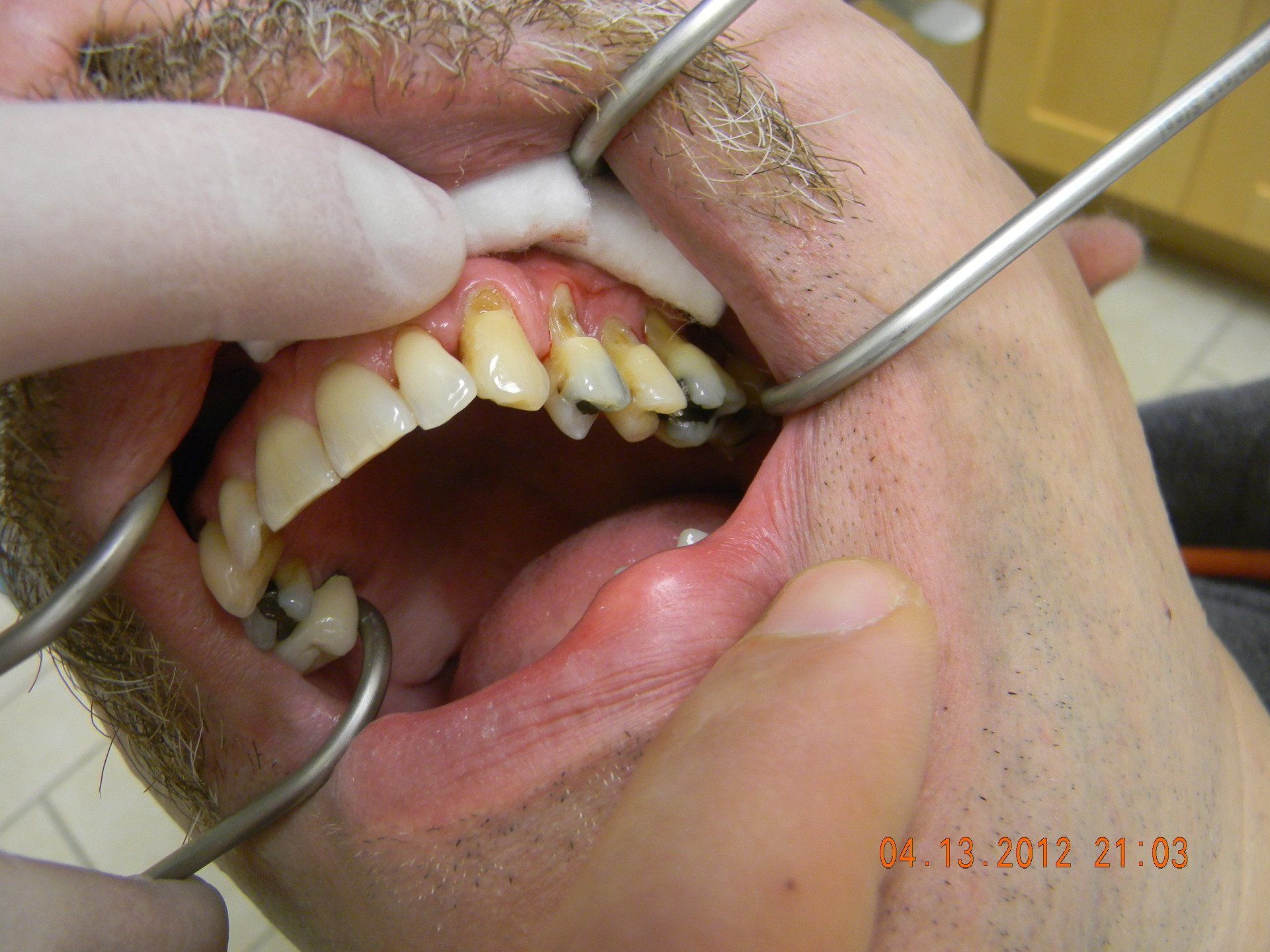 A man is getting his teeth examined by a dentist